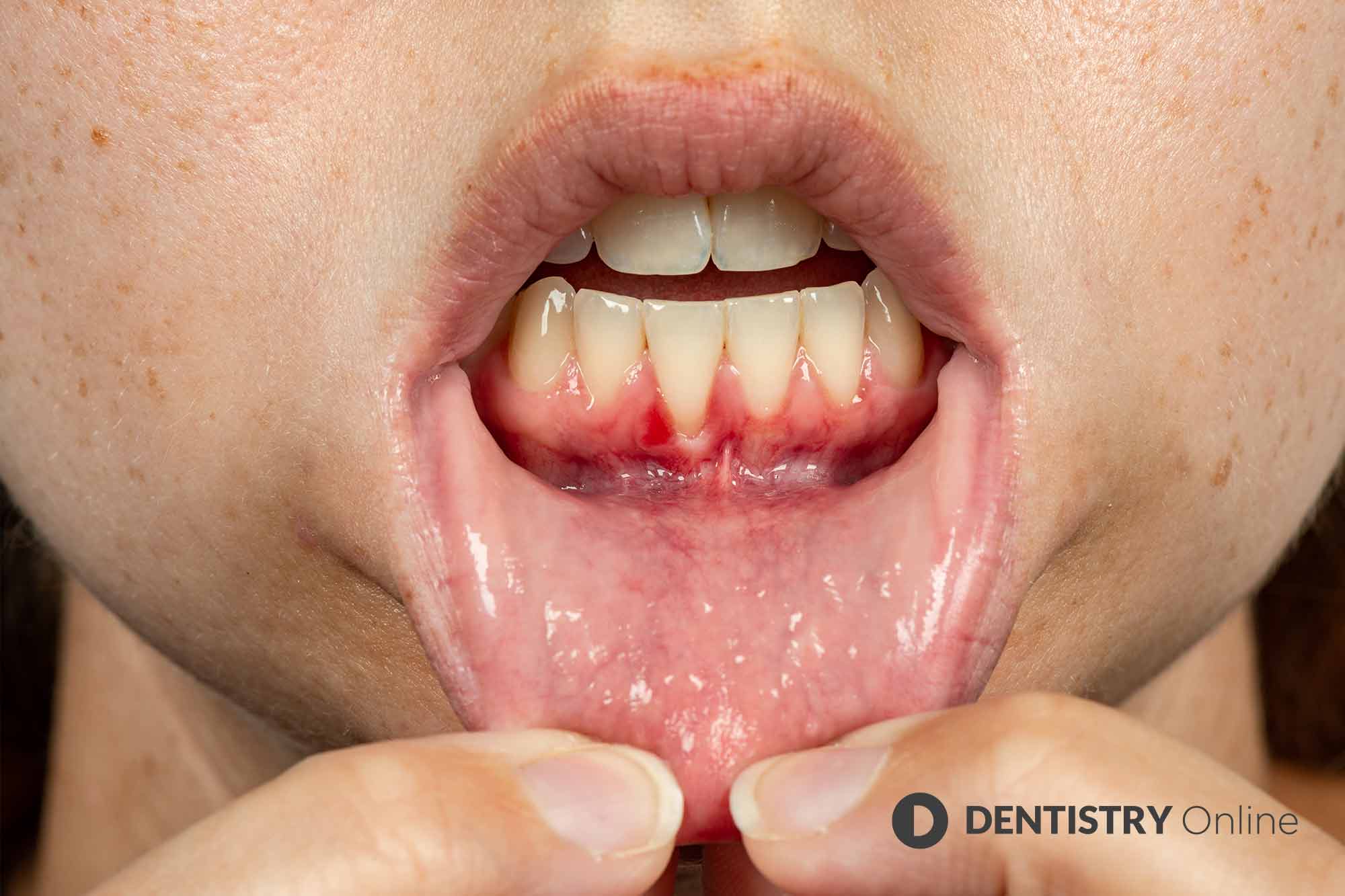 Patients with gum disease are three time more likely to suffer from complications if they contract COVID-19