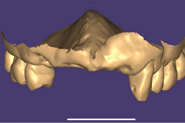 Dentures