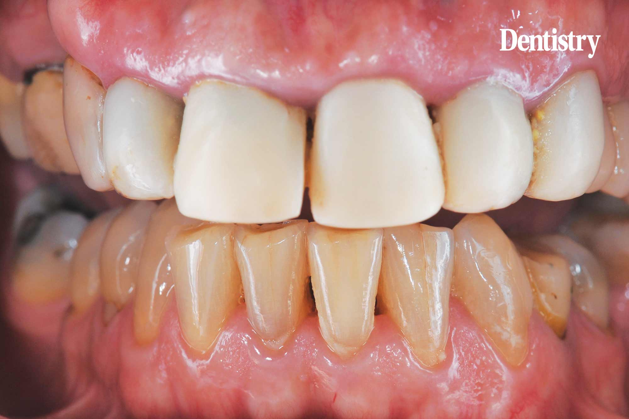 Digital workflow: a game changer for implant restoration