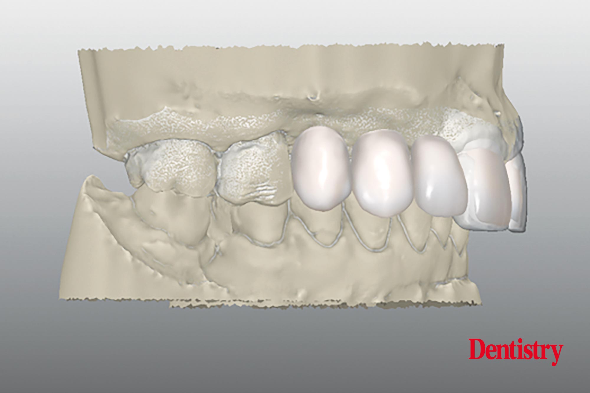 Digital workflow: a game changer for implant restoration