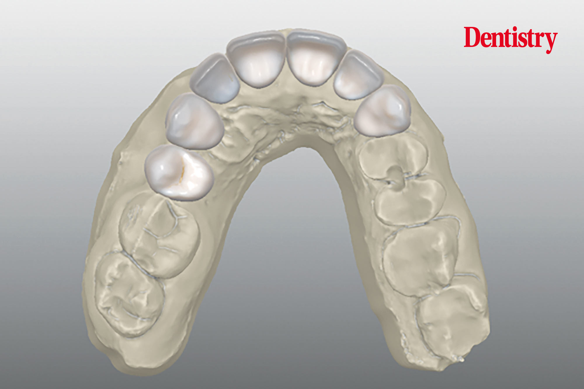 Digital workflow: a game changer for implant restoration