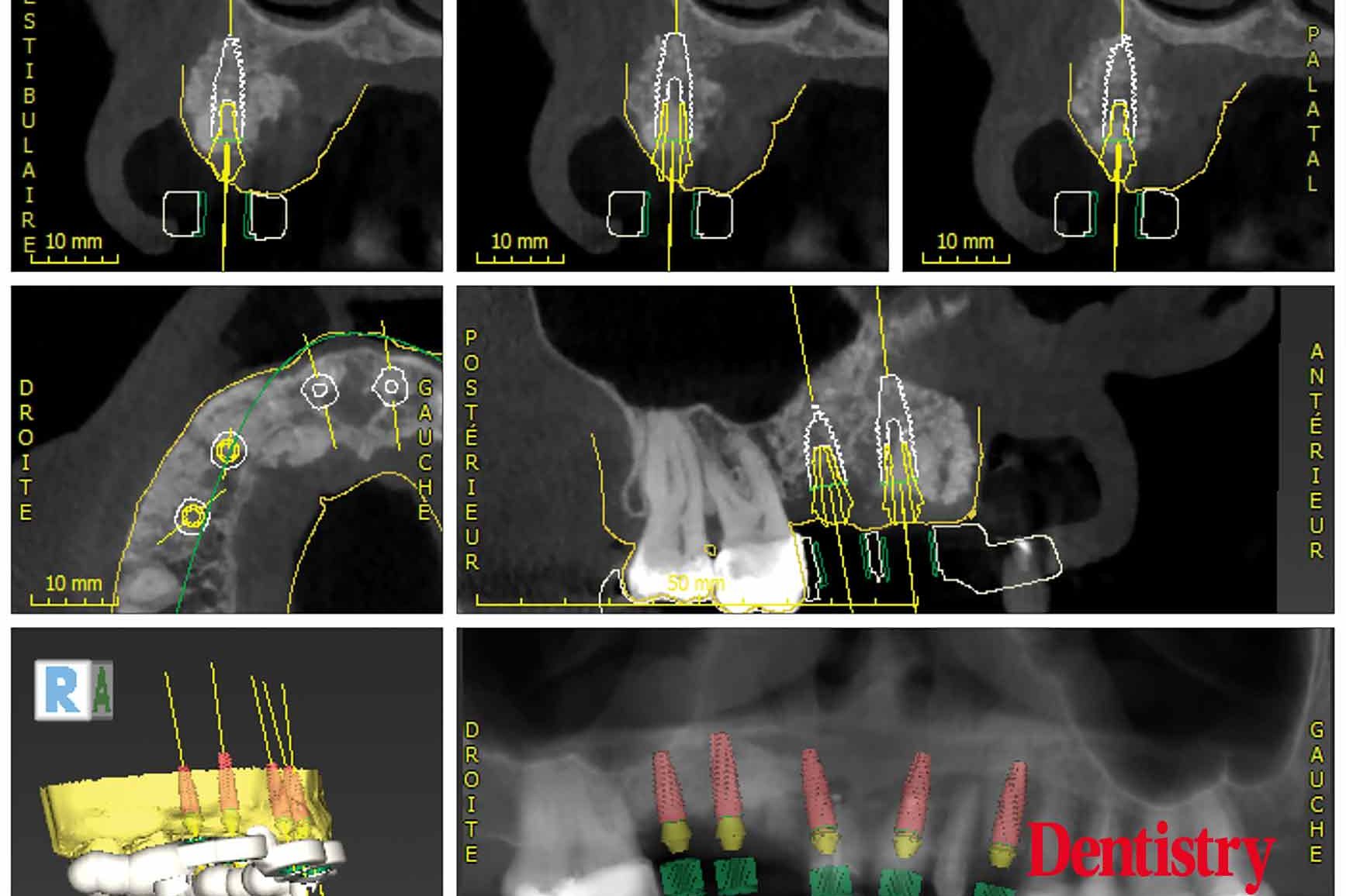 Digital workflow: a game changer for implant restoration