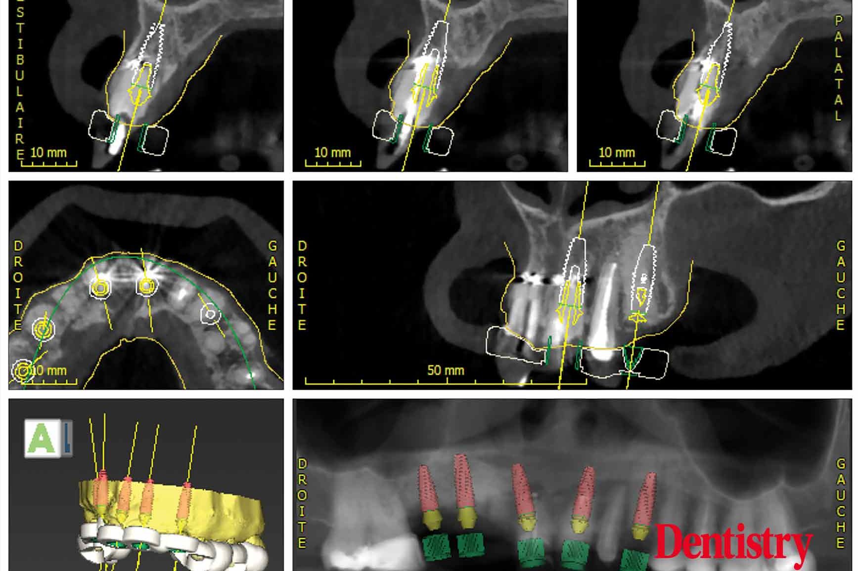 Digital workflow: a game changer for implant restoration