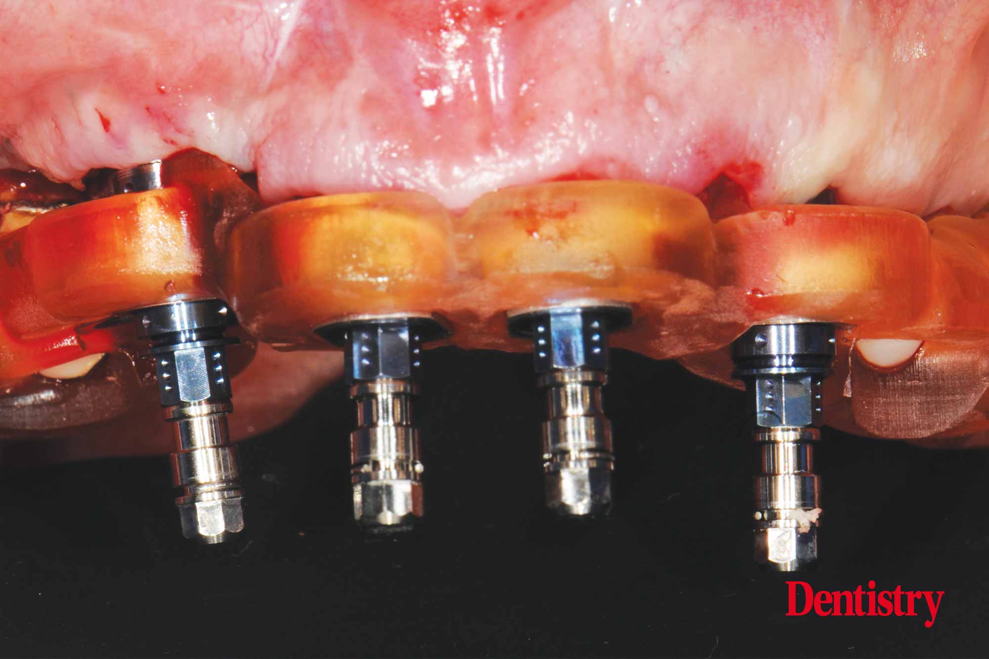Digital workflow: a game changer for implant restoration