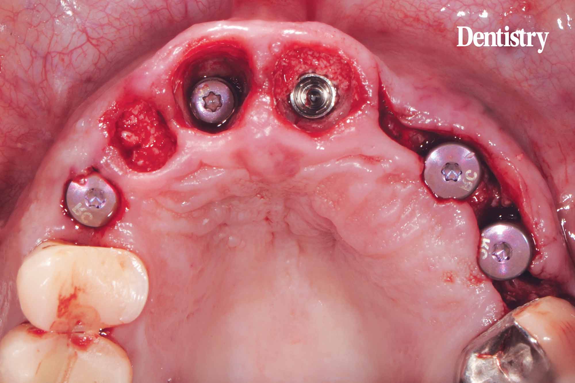 Digital workflow: a game changer for implant restoration