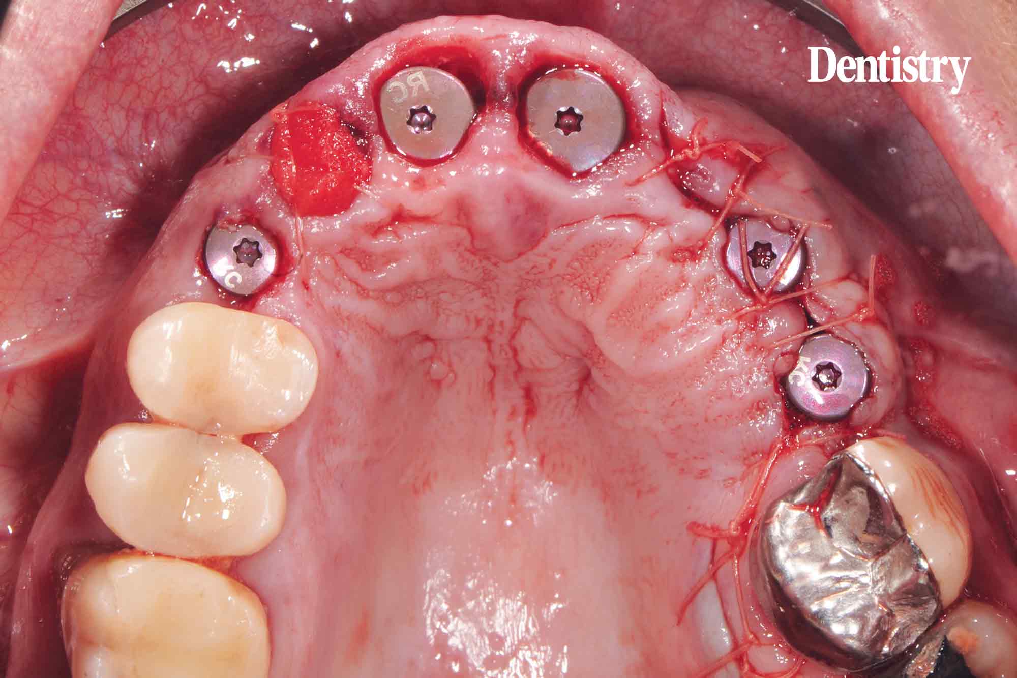 Digital workflow: a game changer for implant restoration
