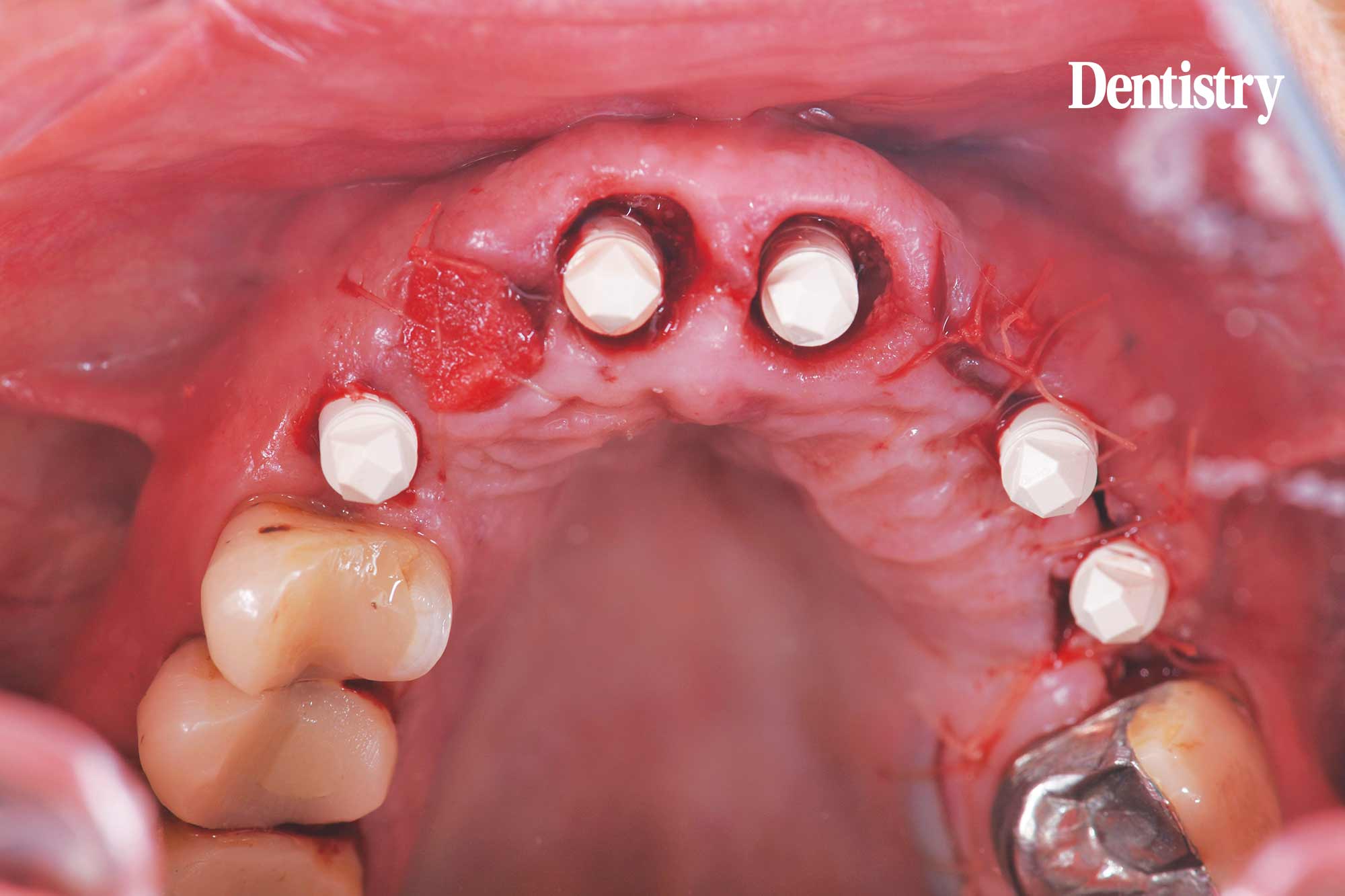 Digital workflow: a game changer for implant restoration