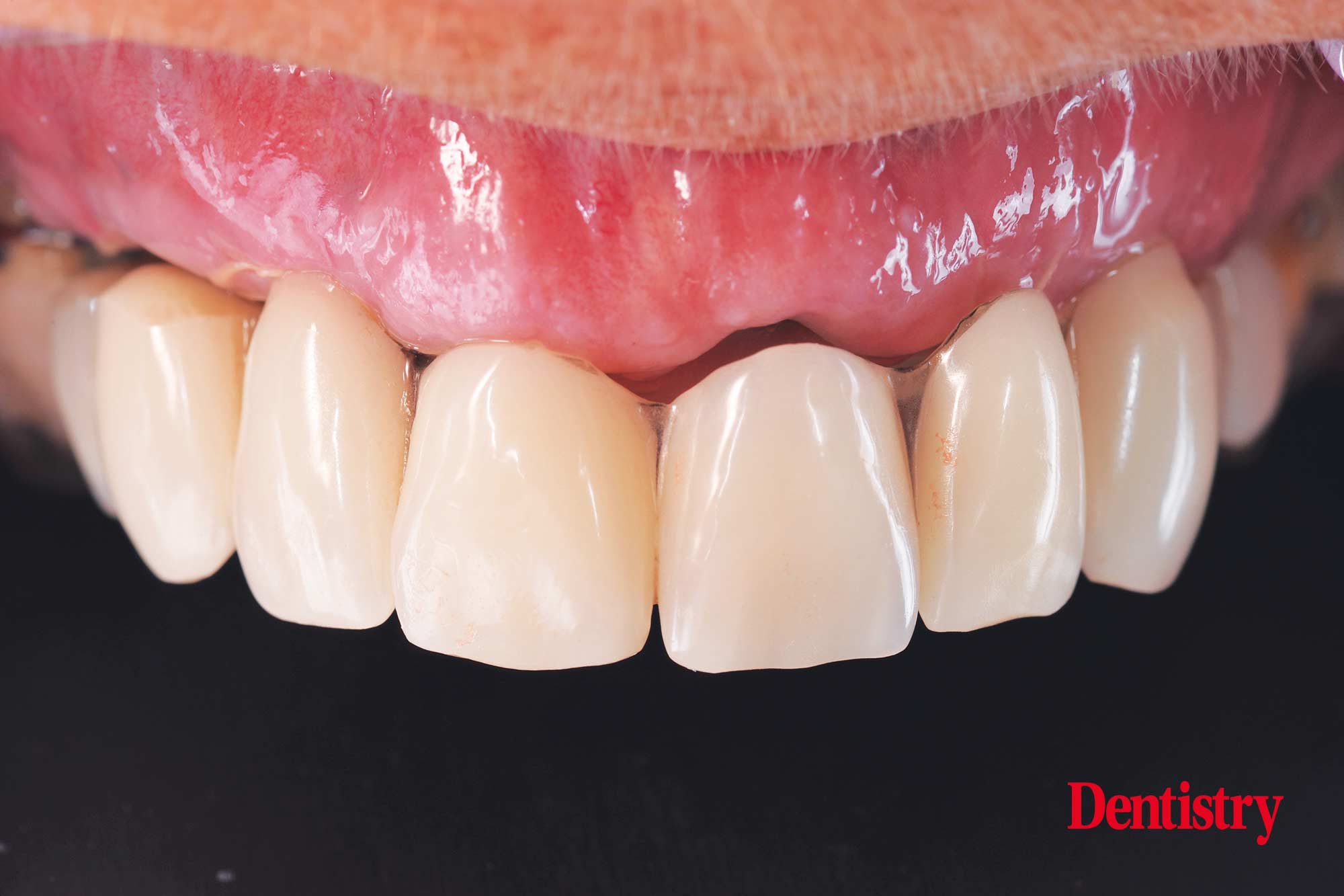 Digital workflow: a game changer for implant restoration