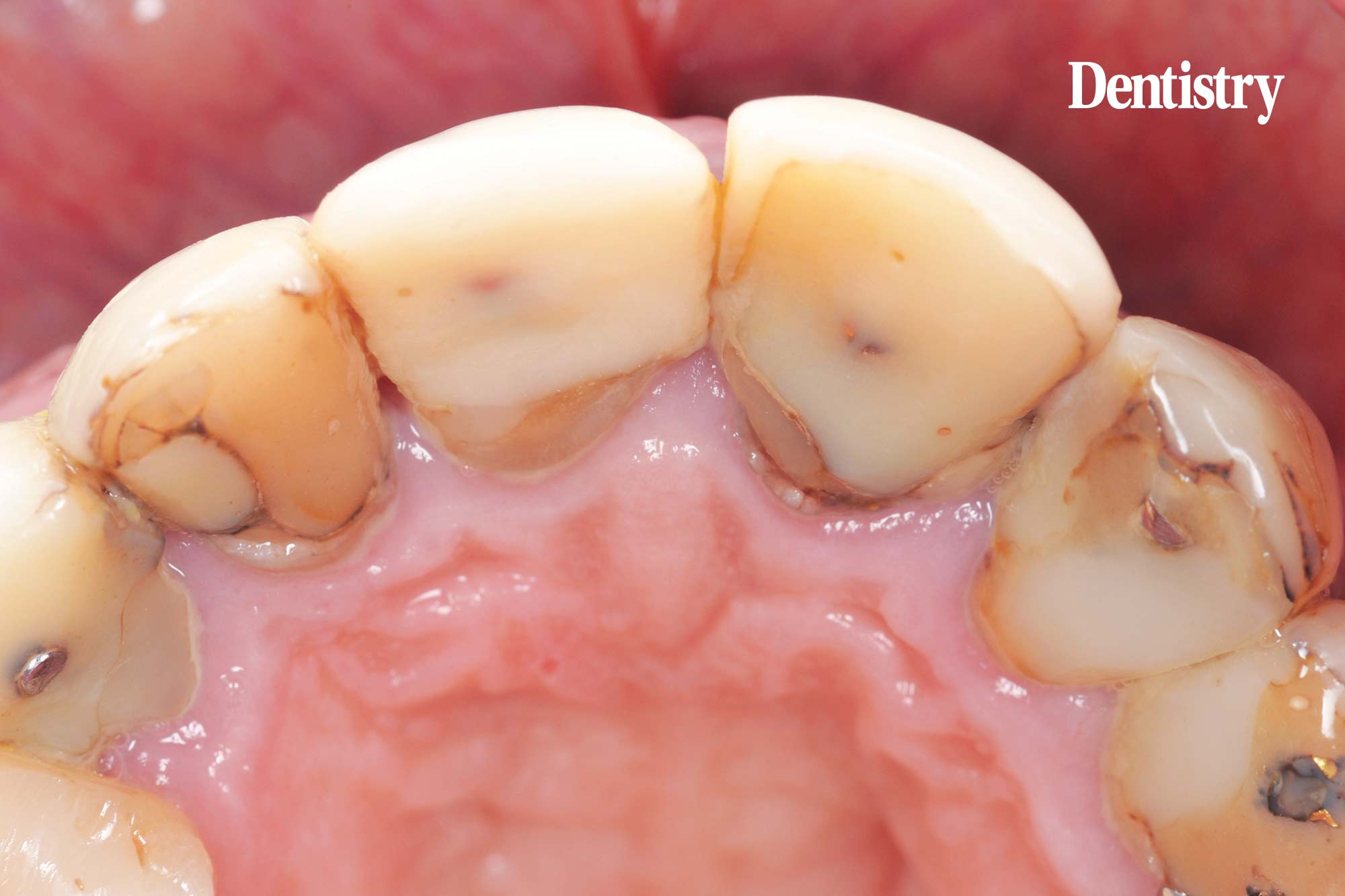 Digital workflow: a game changer for implant restoration