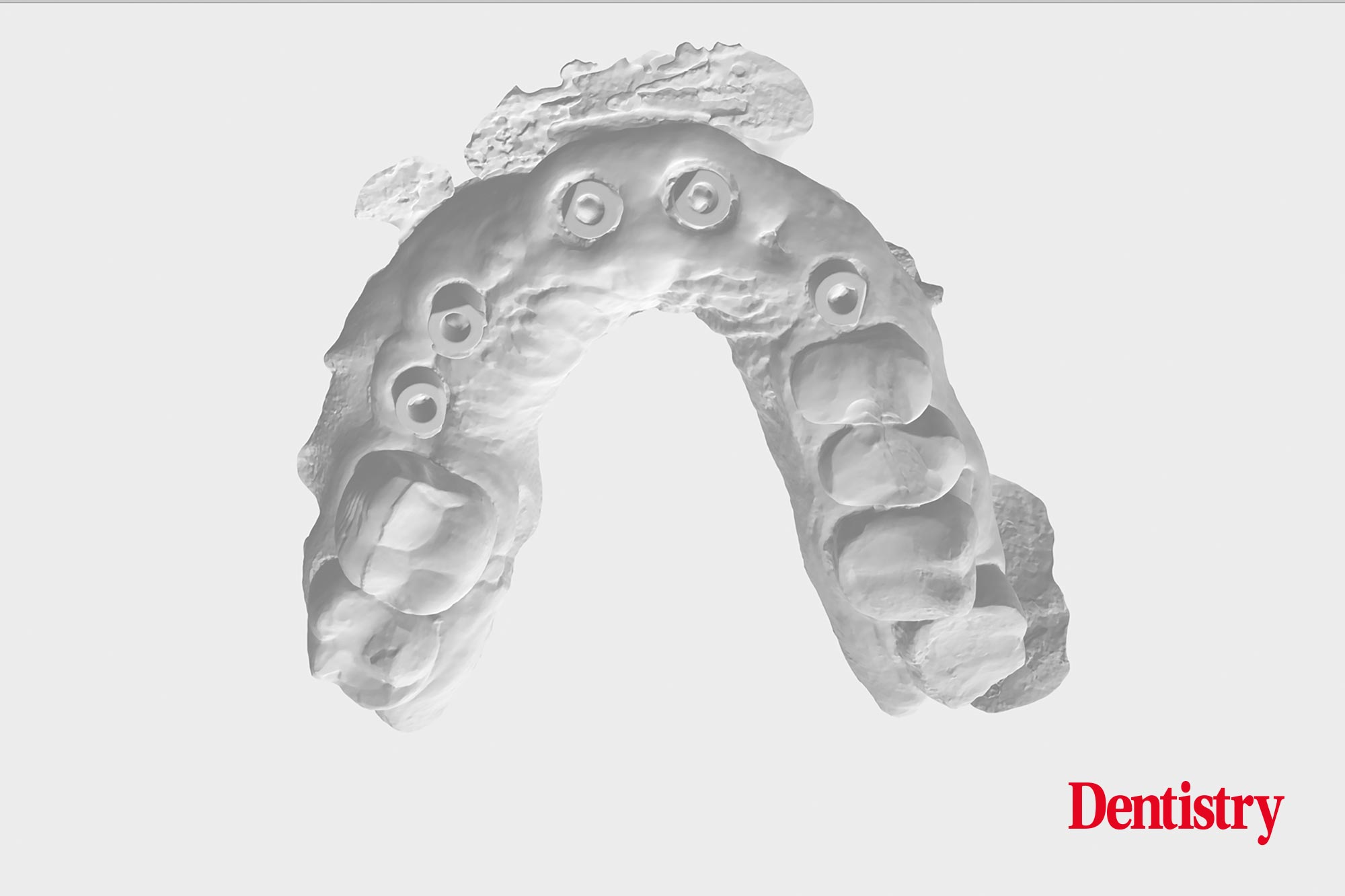 Digital workflow: a game changer for implant restoration