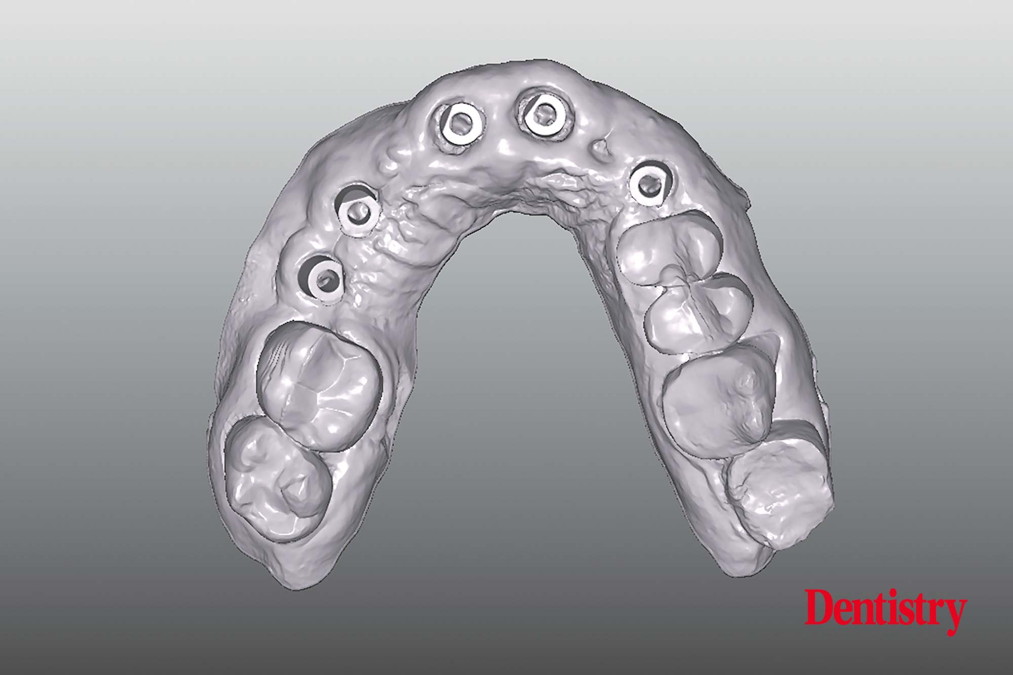 Digital workflow: a game changer for implant restoration