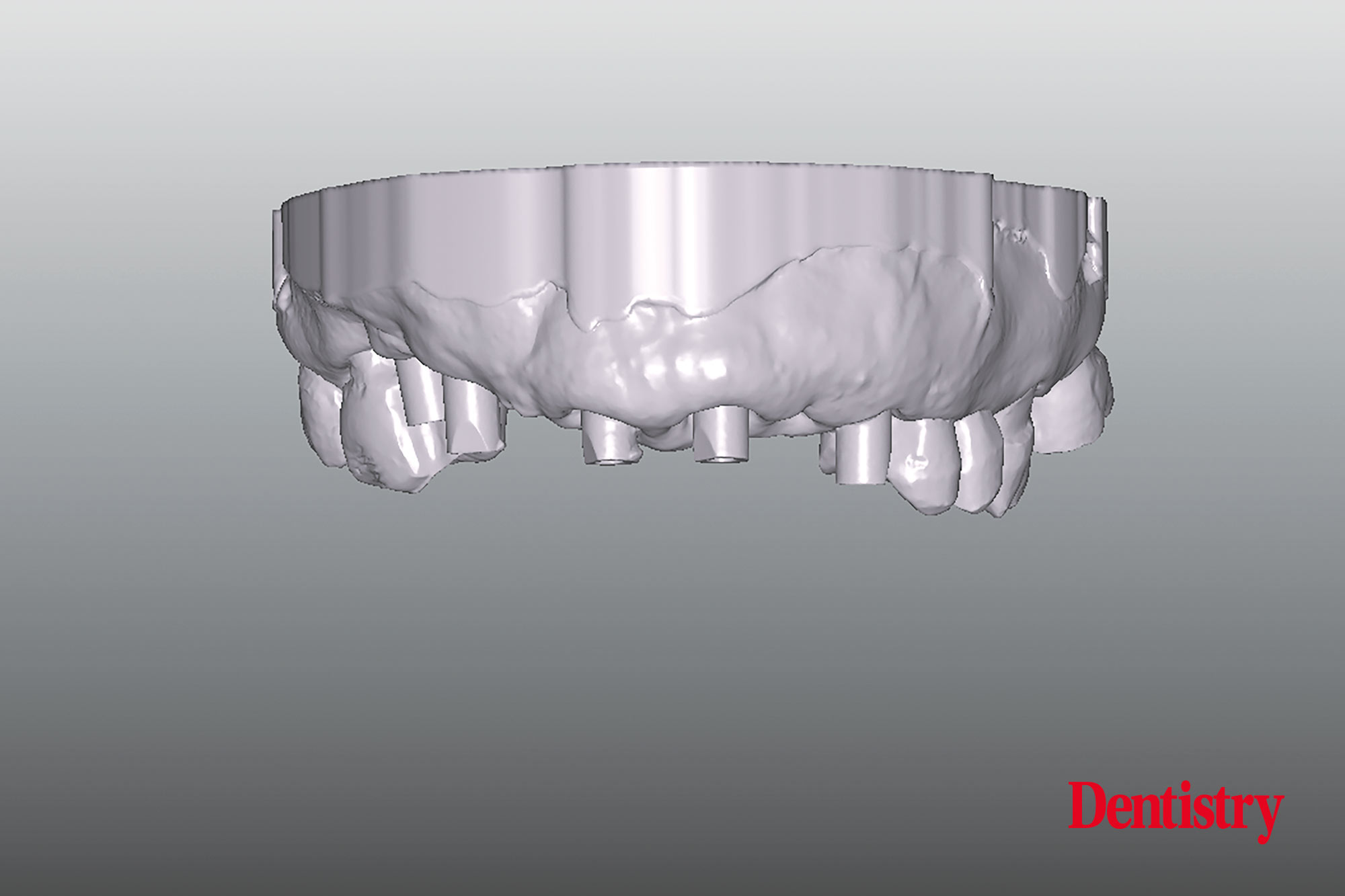 Digital workflow: a game changer for implant restoration
