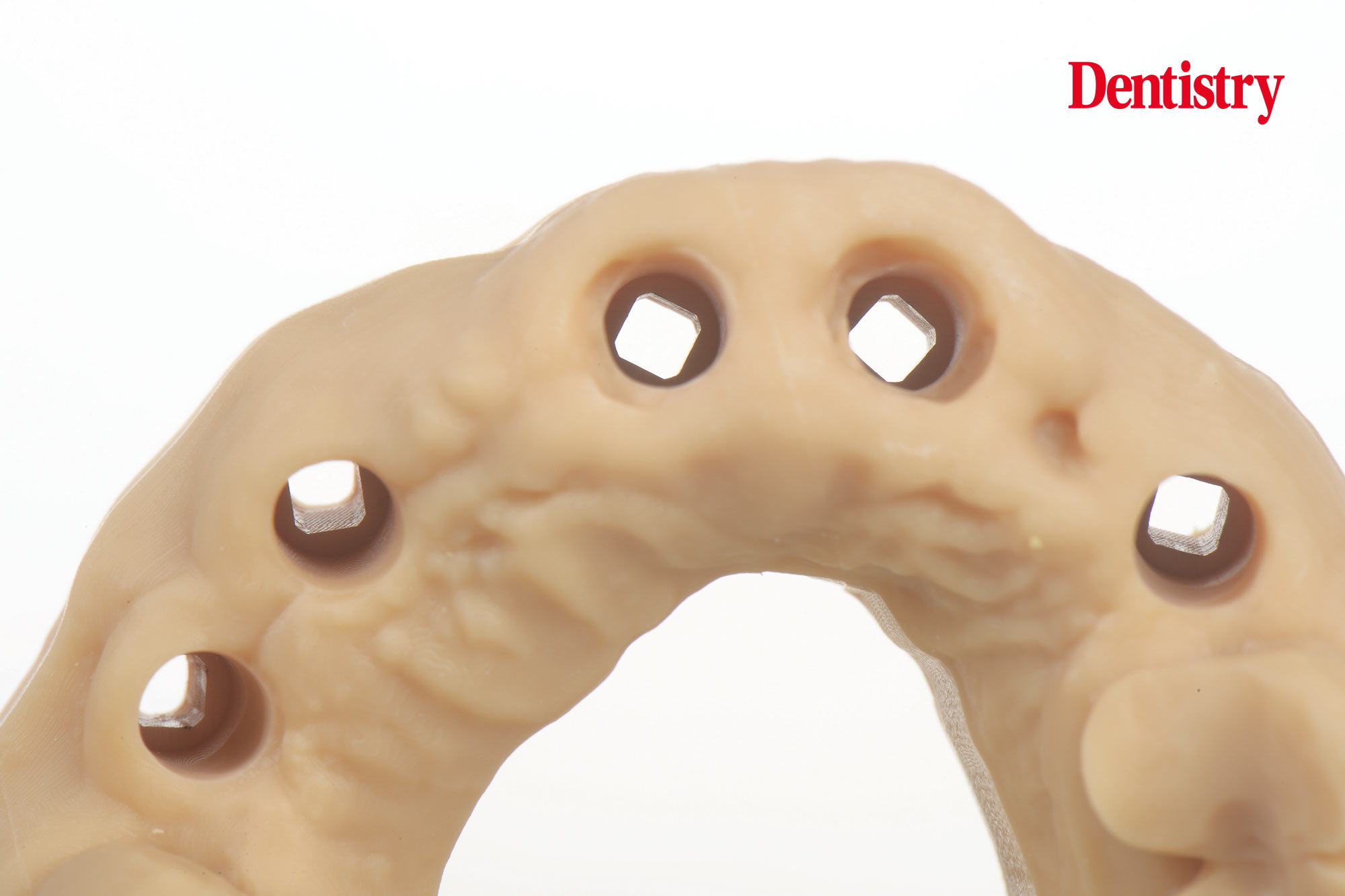 Digital workflow: a game changer for implant restoration