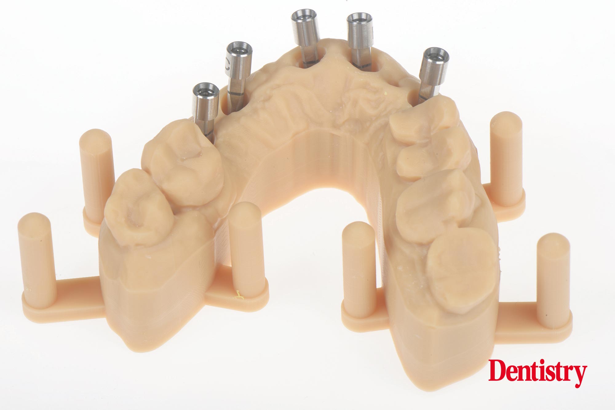 Digital workflow: a game changer for implant restoration