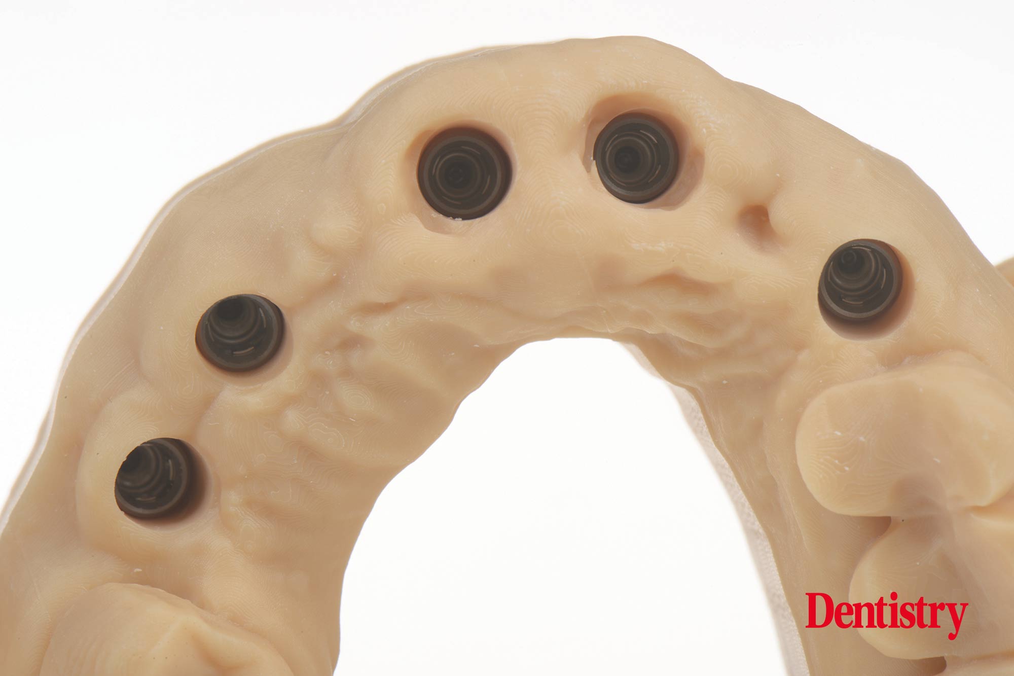 Digital workflow: a game changer for implant restoration