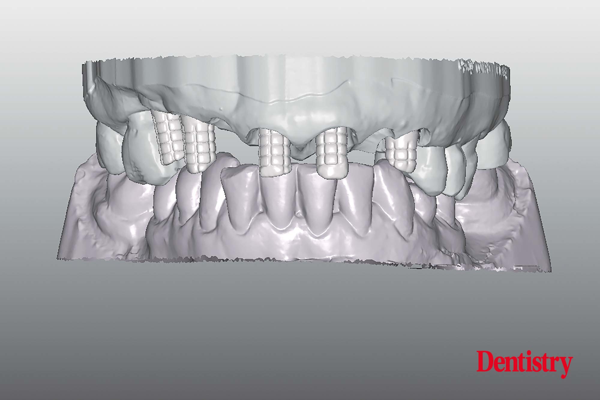 Digital workflow: a game changer for implant restoration