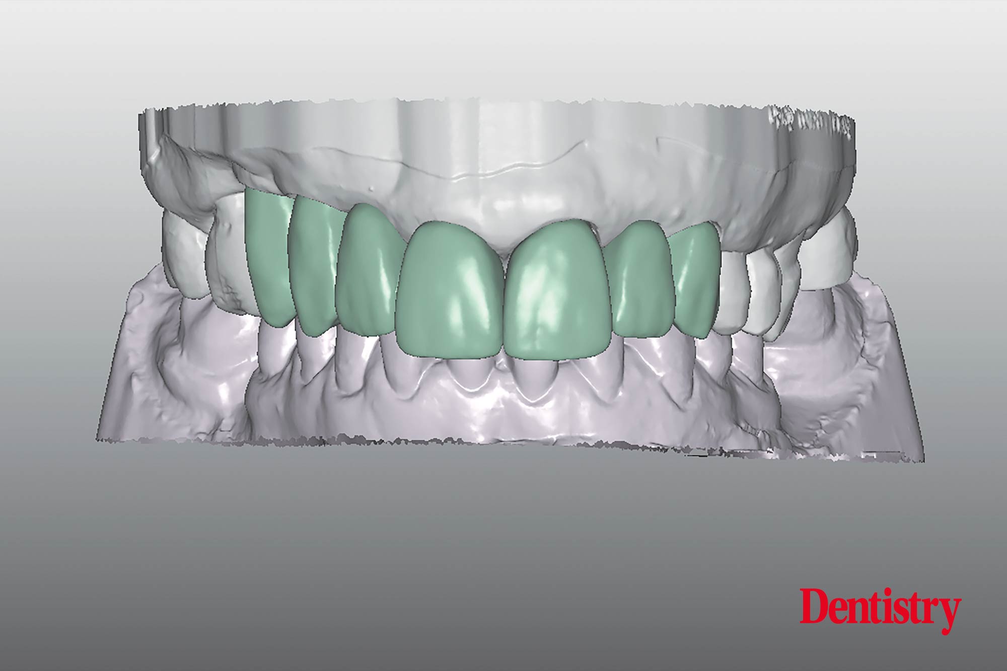 Digital workflow: a game changer for implant restoration