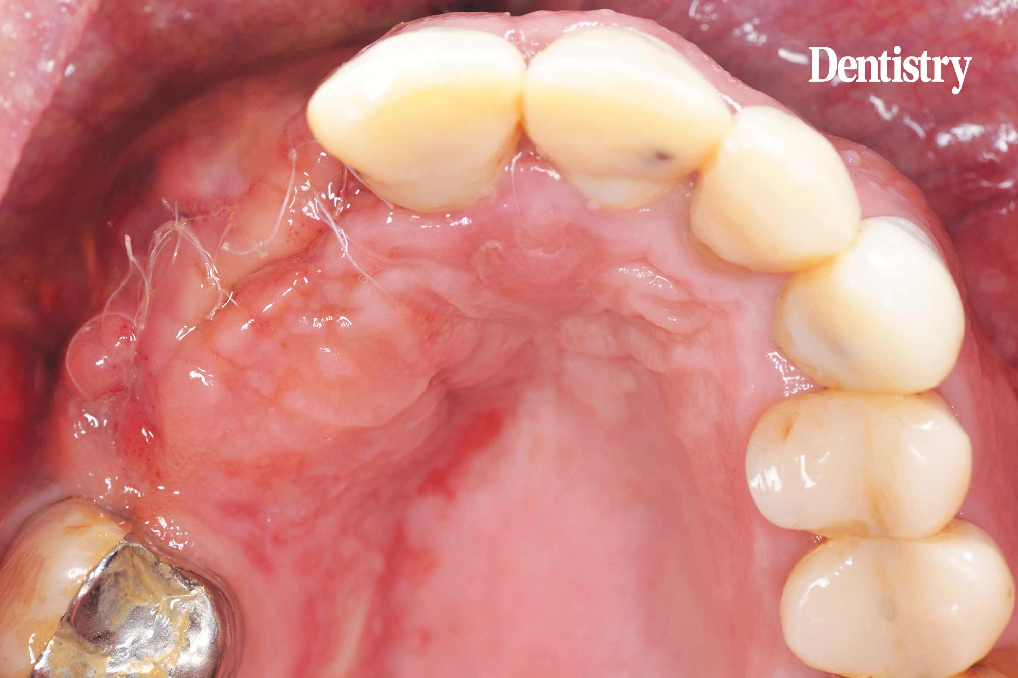 Digital workflow: a game changer for implant restoration