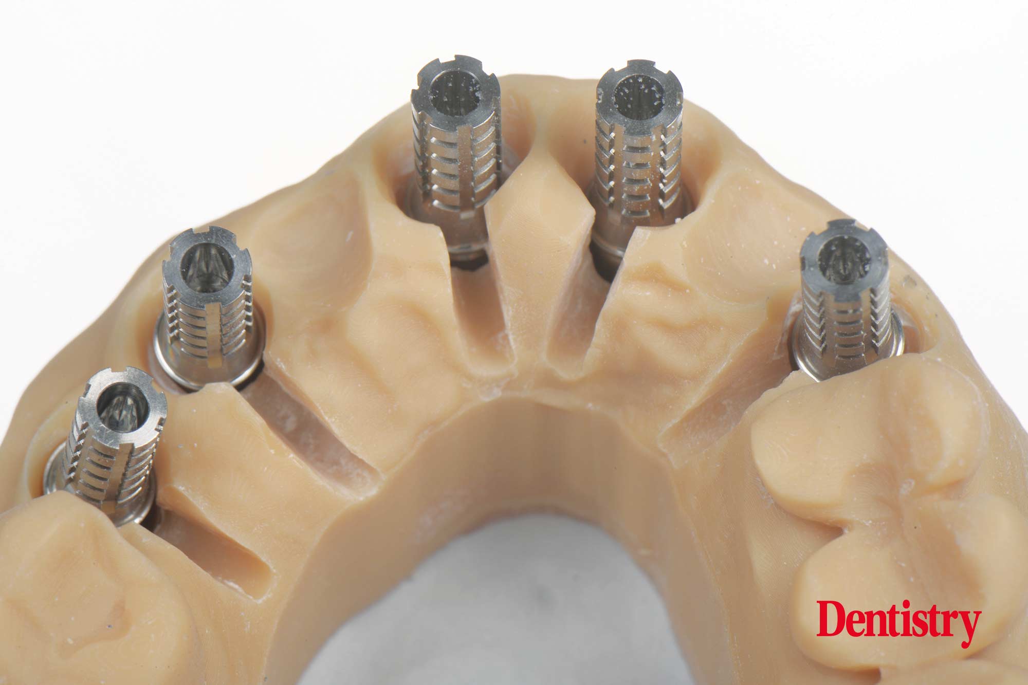 Digital workflow: a game changer for implant restoration