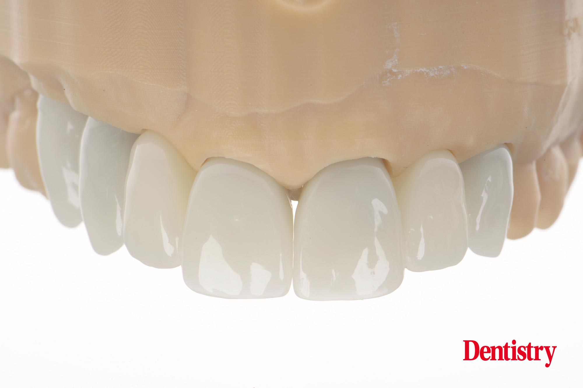 Digital workflow: a game changer for implant restoration