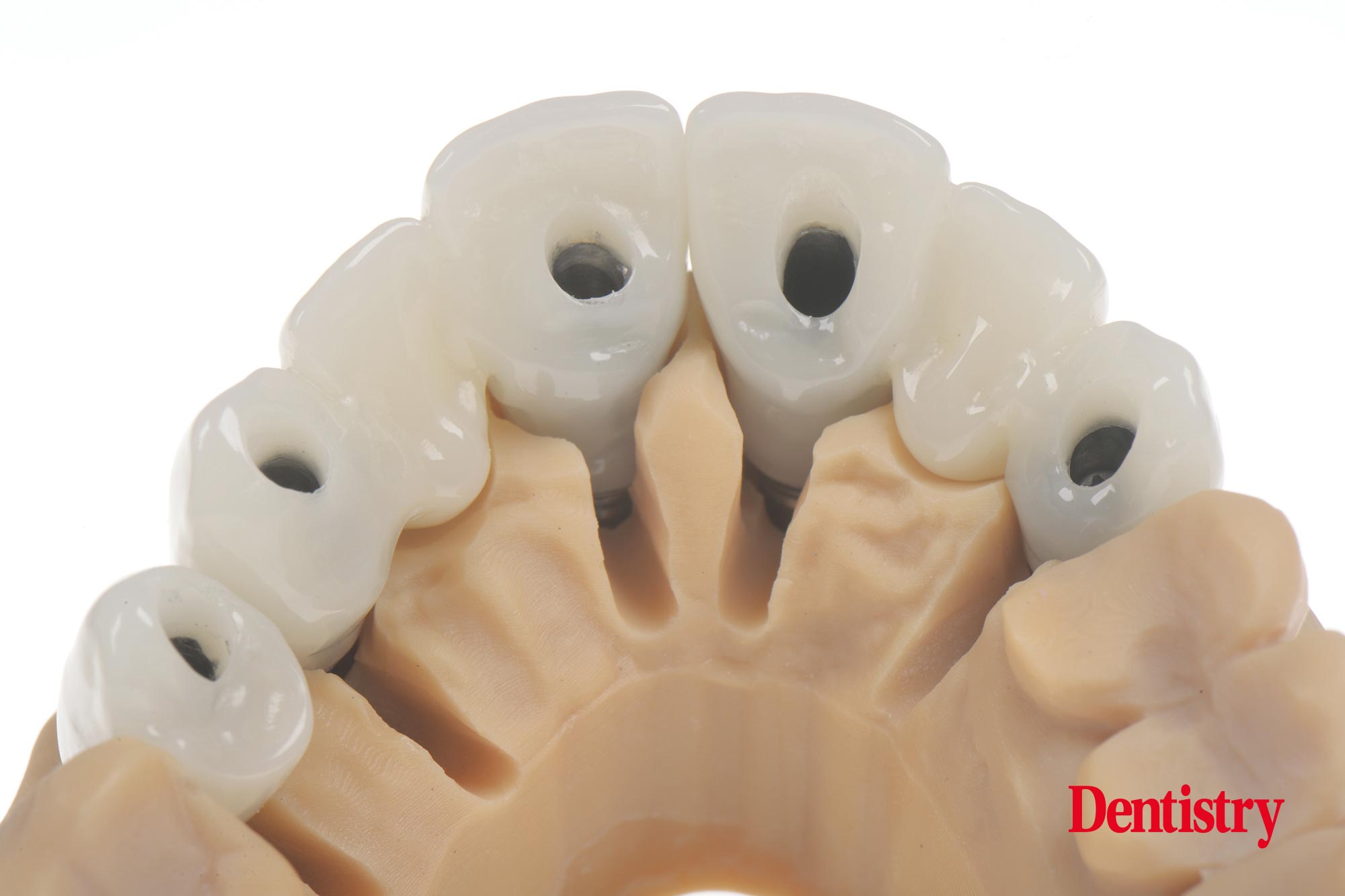 Digital workflow: a game changer for implant restoration