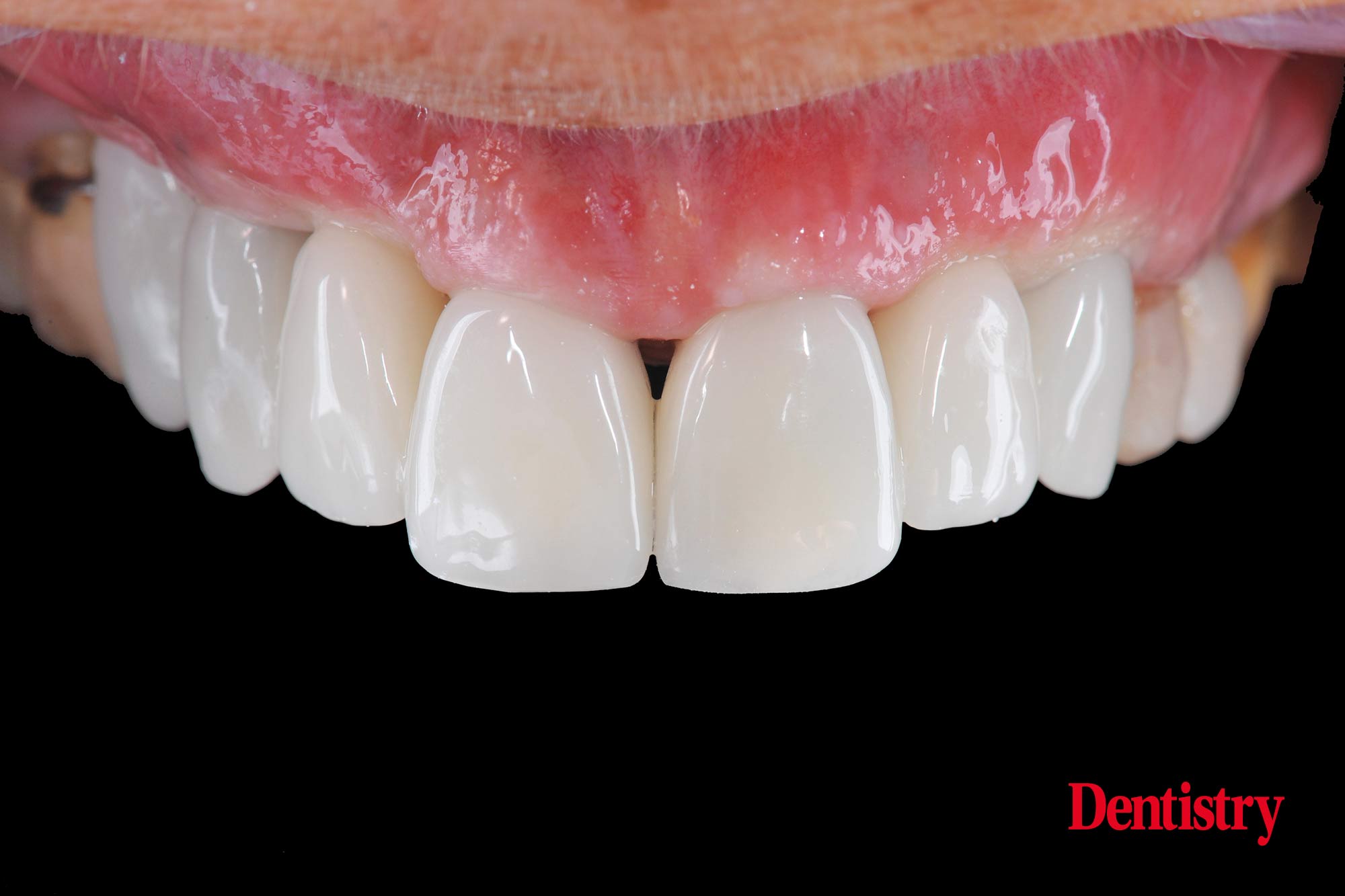 Digital workflow: a game changer for implant restoration