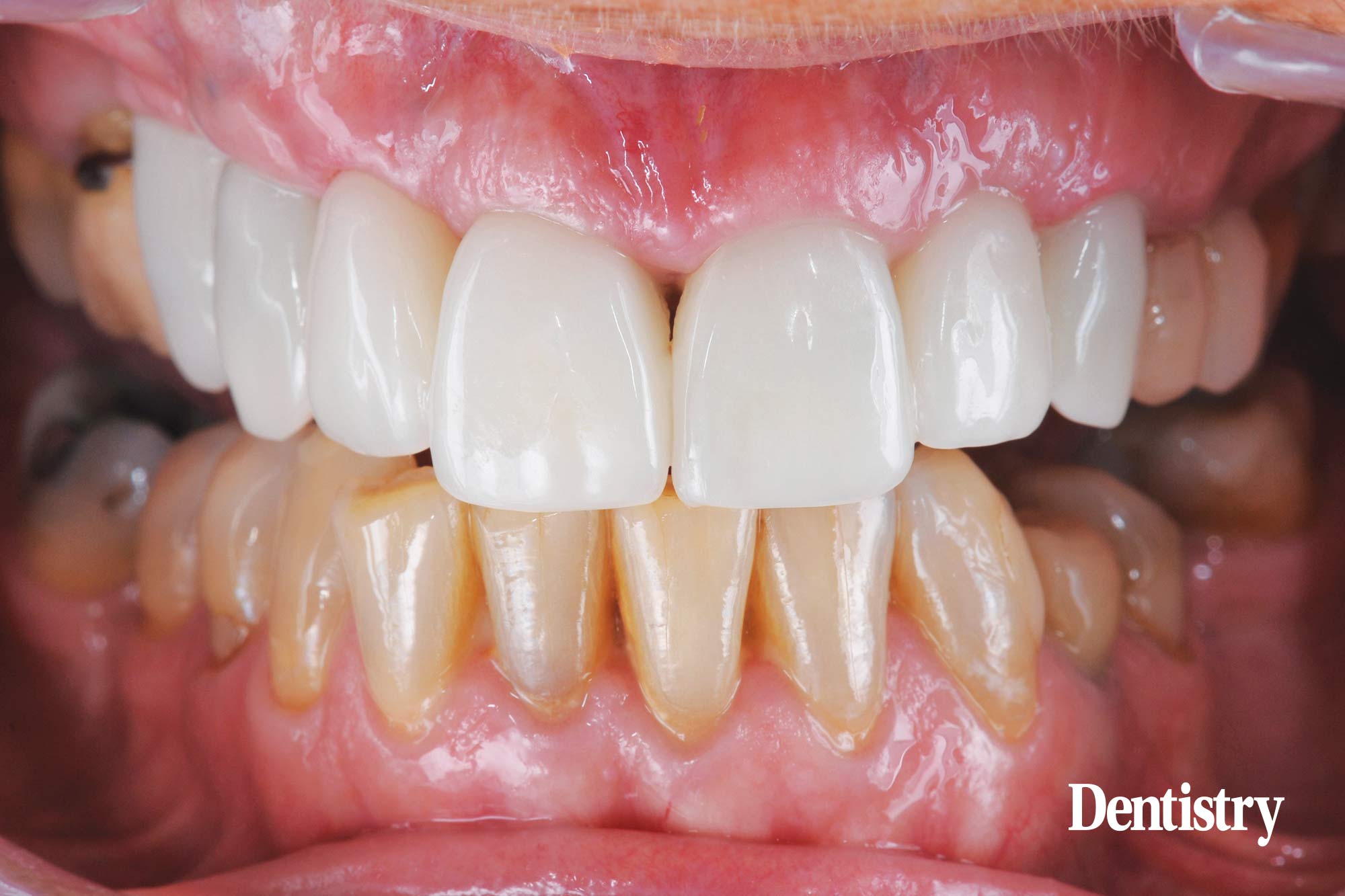 Digital workflow: a game changer for implant restoration
