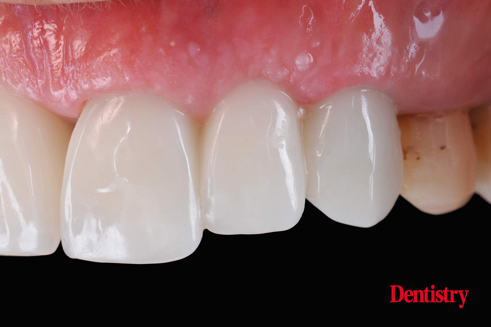 Digital workflow: a game changer for implant restoration