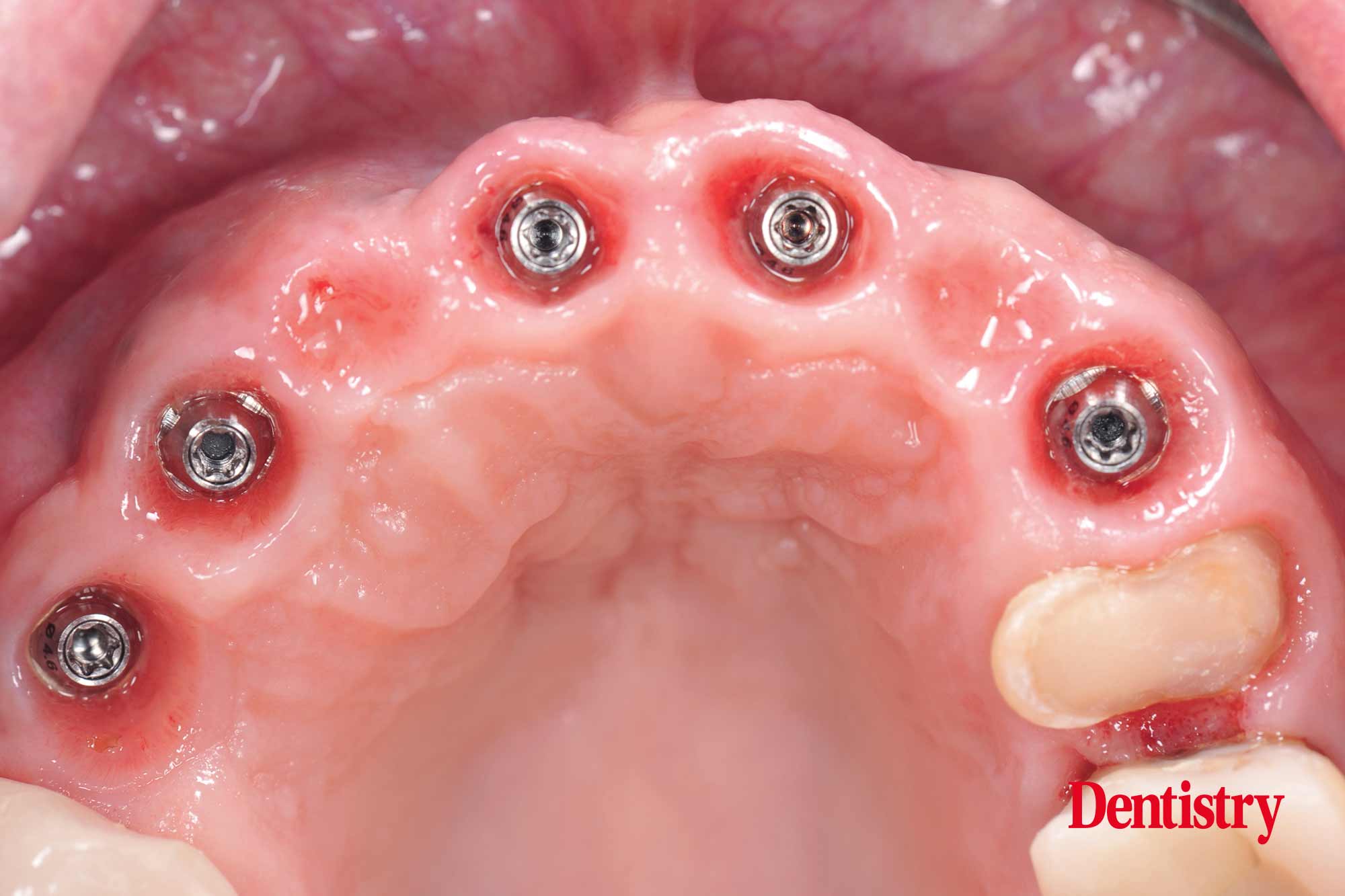 Digital workflow: a game changer for implant restoration