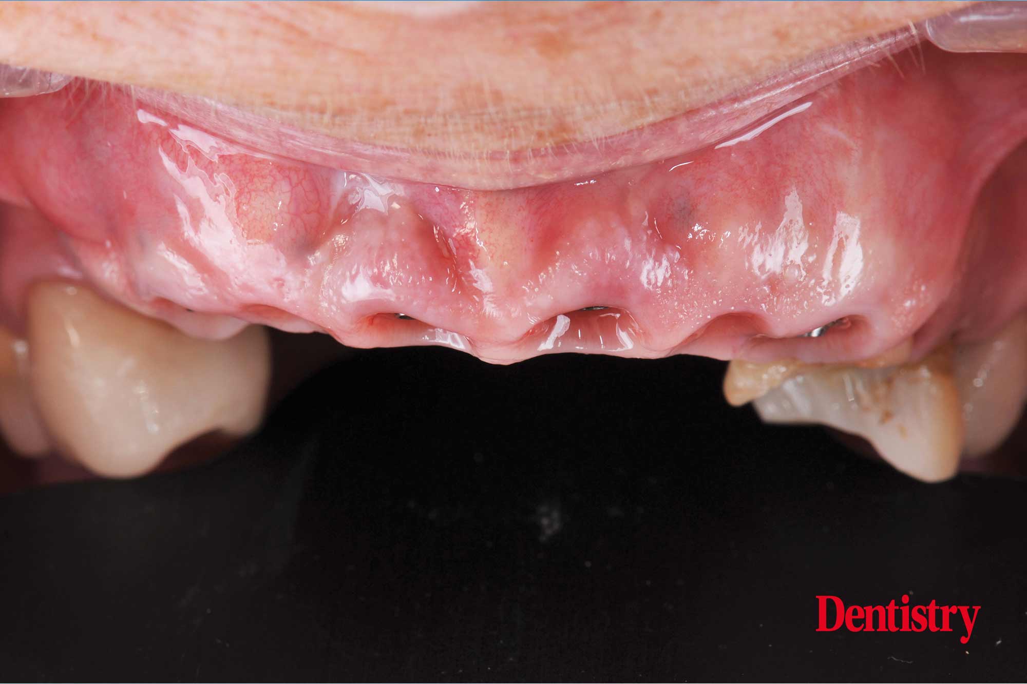 Digital workflow: a game changer for implant restoration