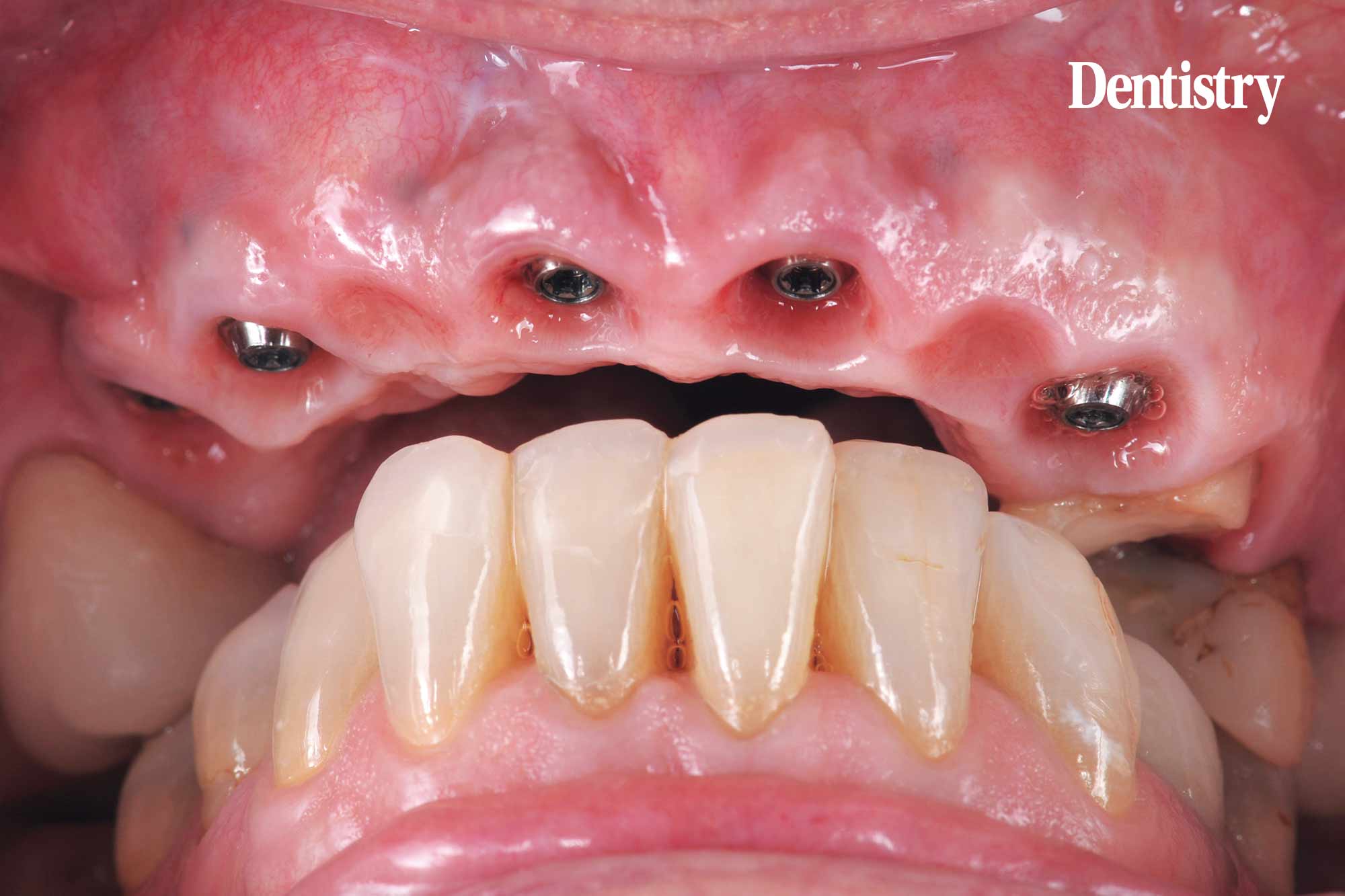 Digital workflow: a game changer for implant restoration