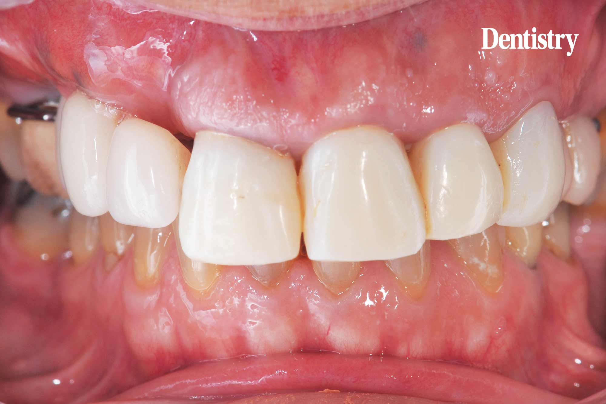 Digital workflow: a game changer for implant restoration