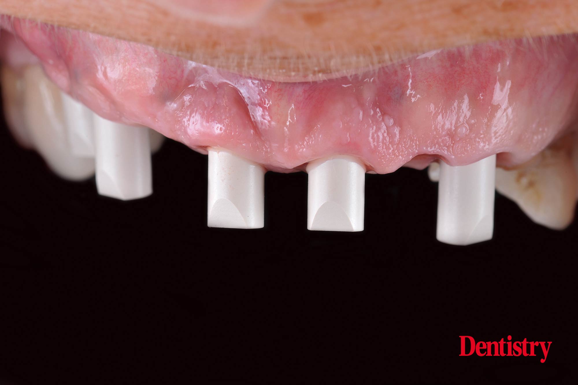 Digital workflow: a game changer for implant restoration