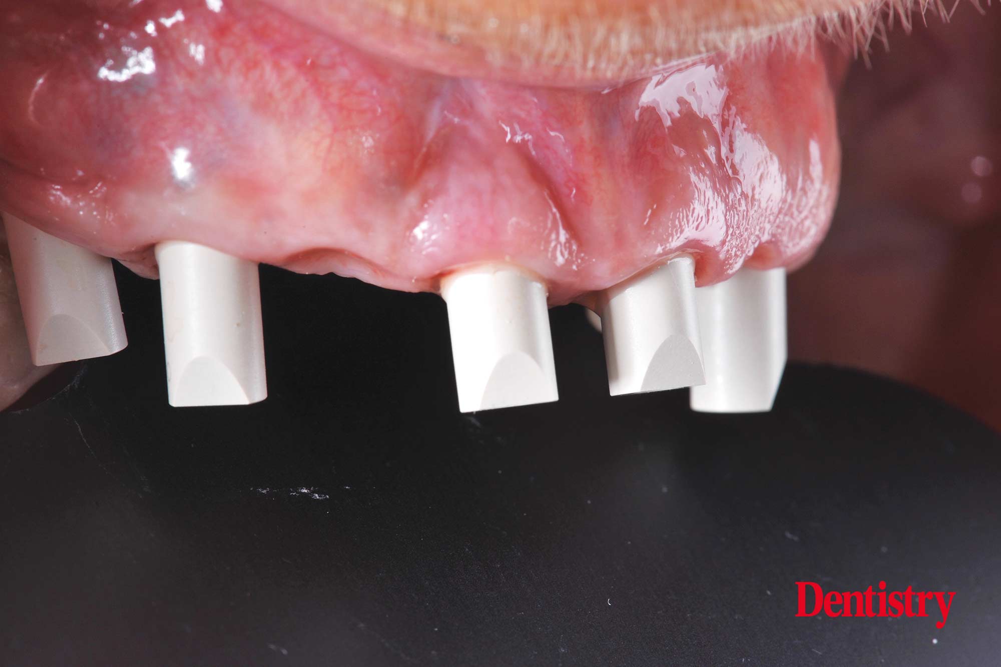 Digital workflow: a game changer for implant restoration