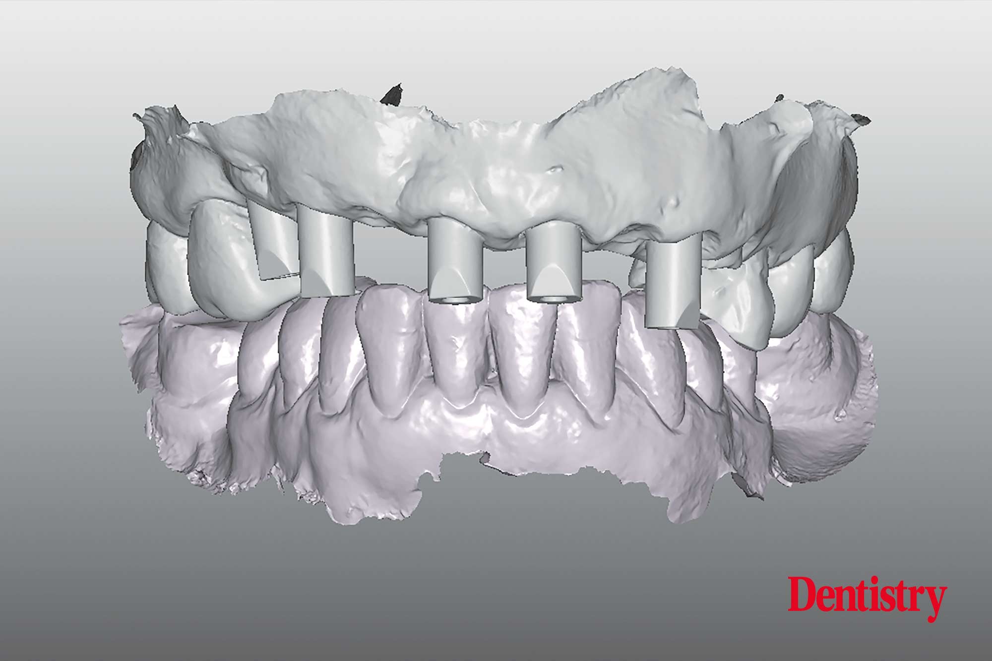 Digital workflow: a game changer for implant restoration