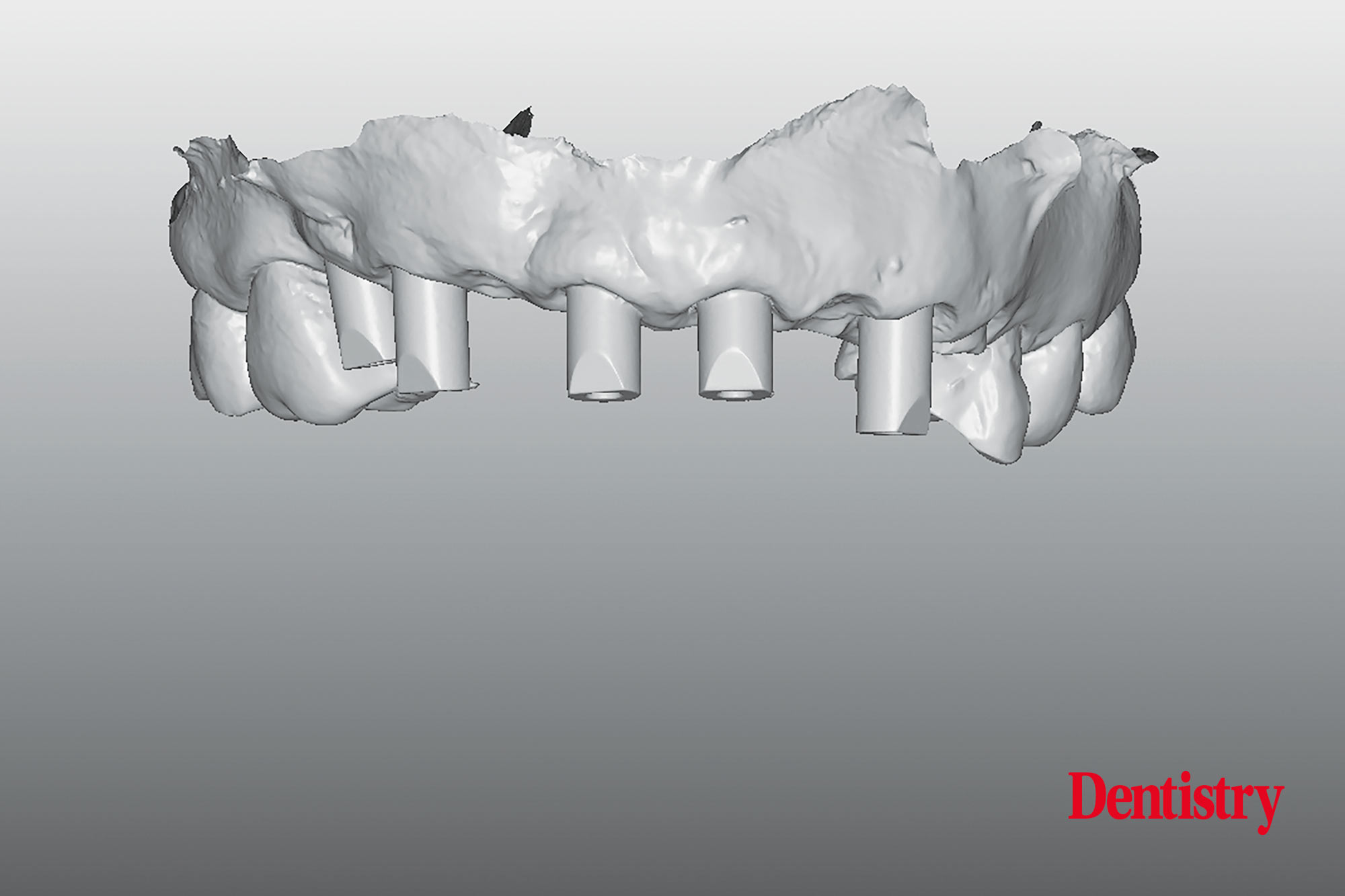 Digital workflow: a game changer for implant restoration