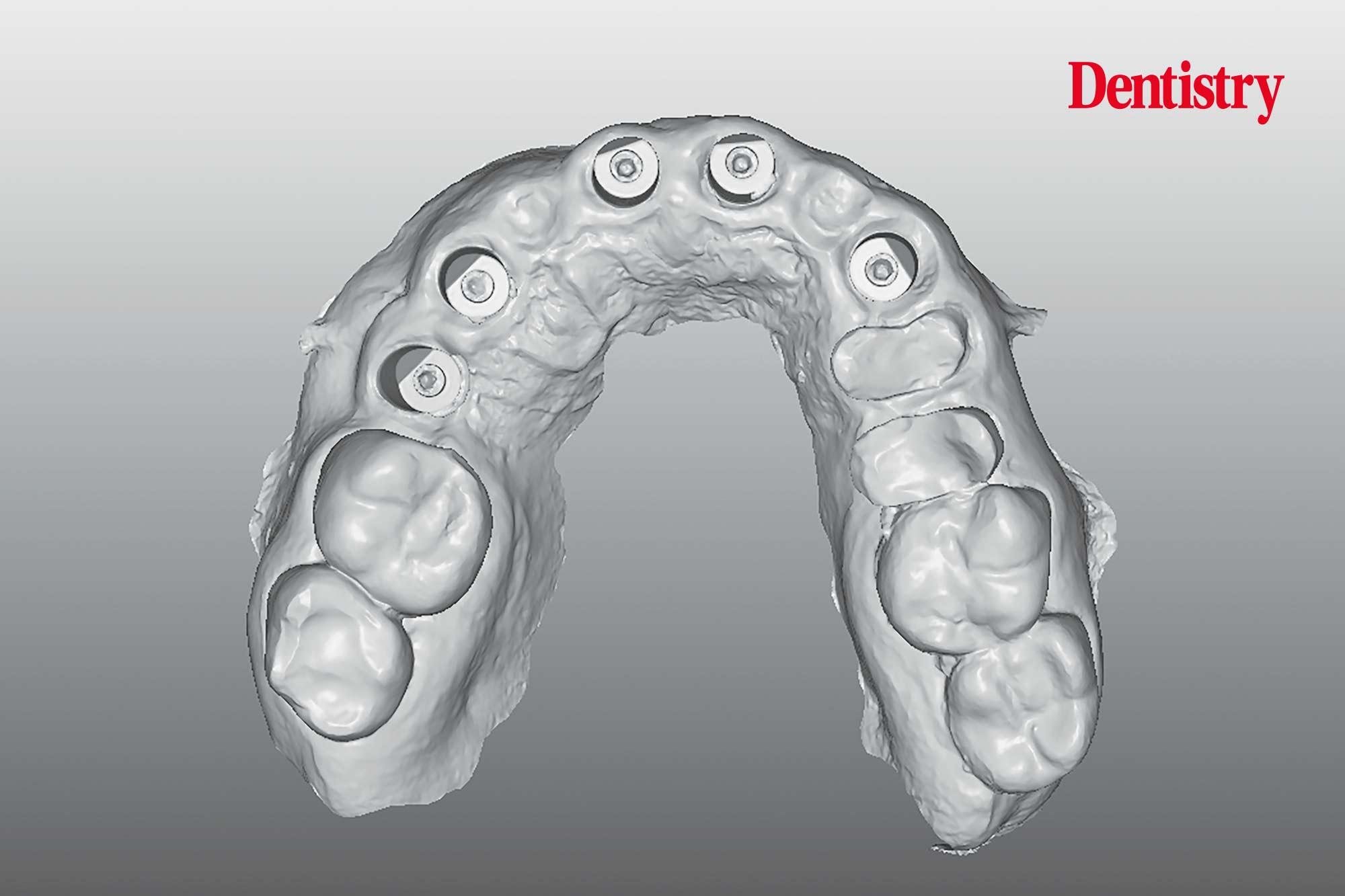 Digital workflow: a game changer for implant restoration