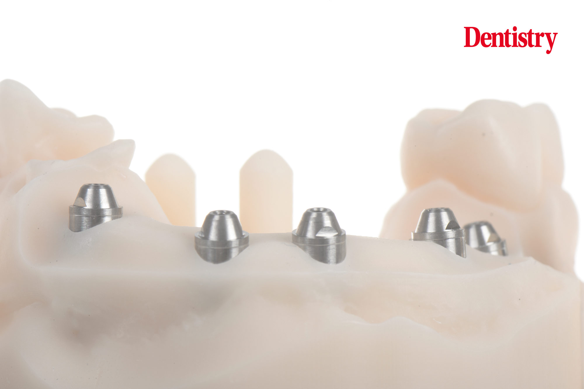Digital workflow: a game changer for implant restoration