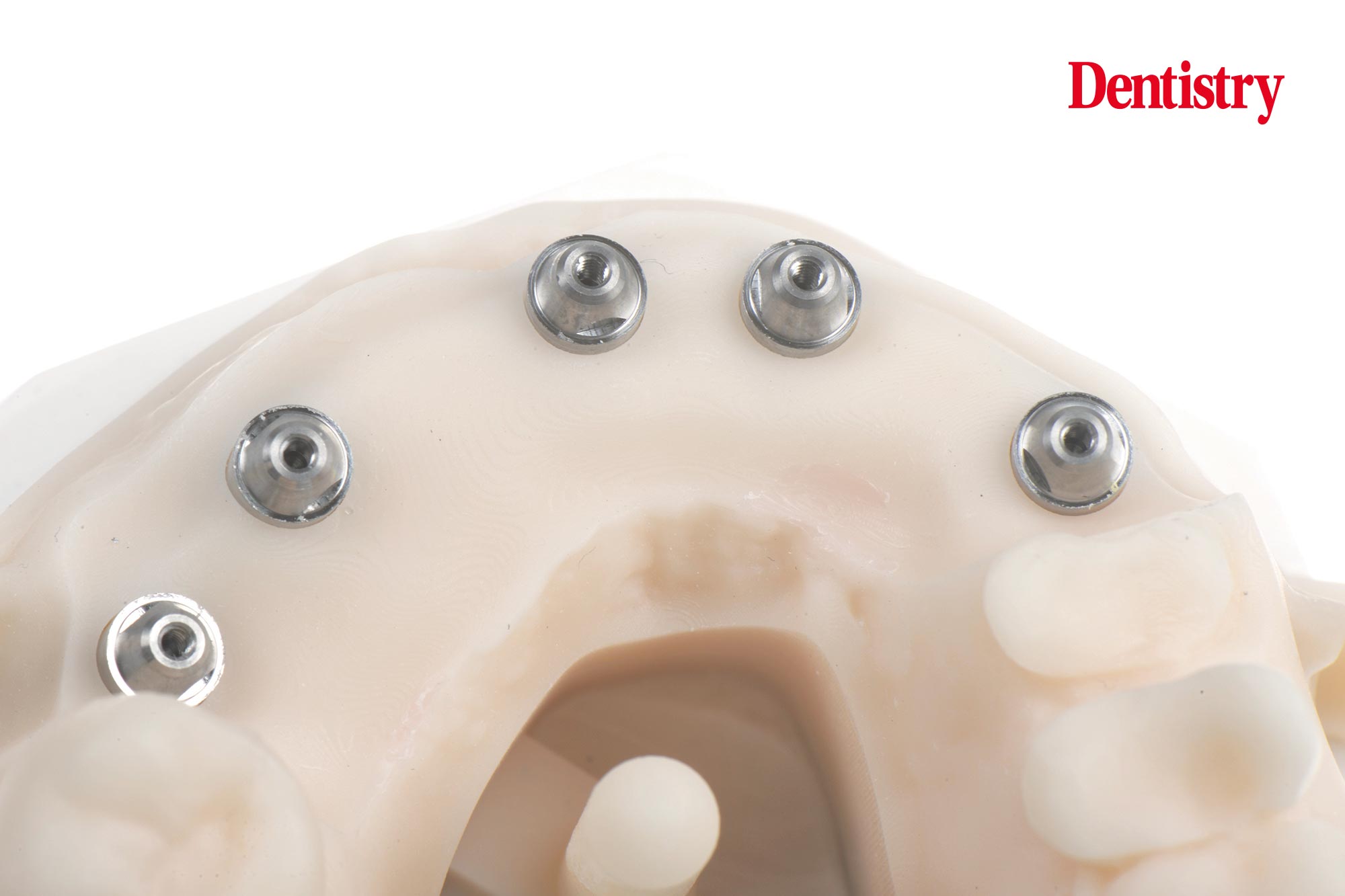 Digital workflow: a game changer for implant restoration