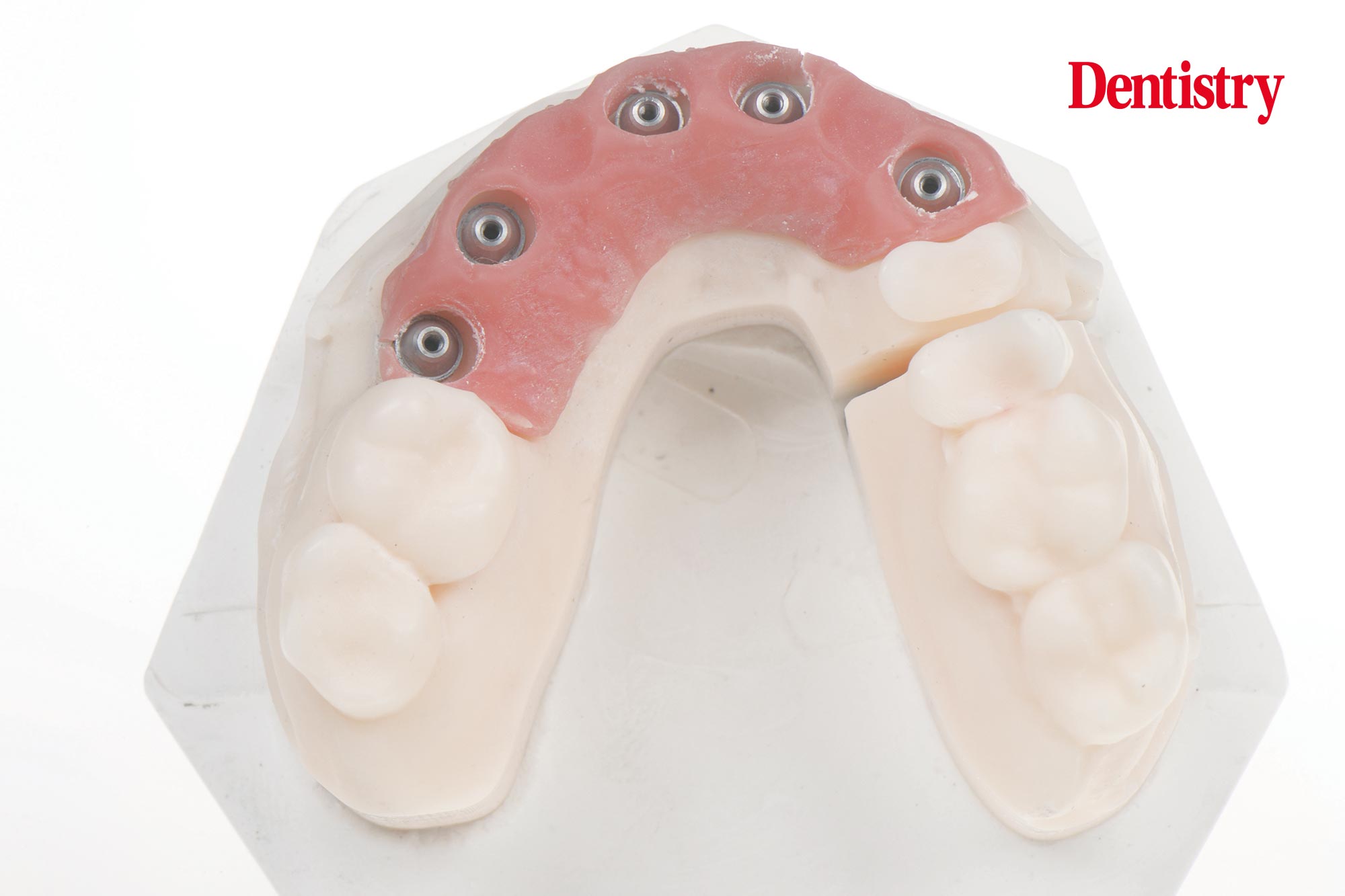 Digital workflow: a game changer for implant restoration