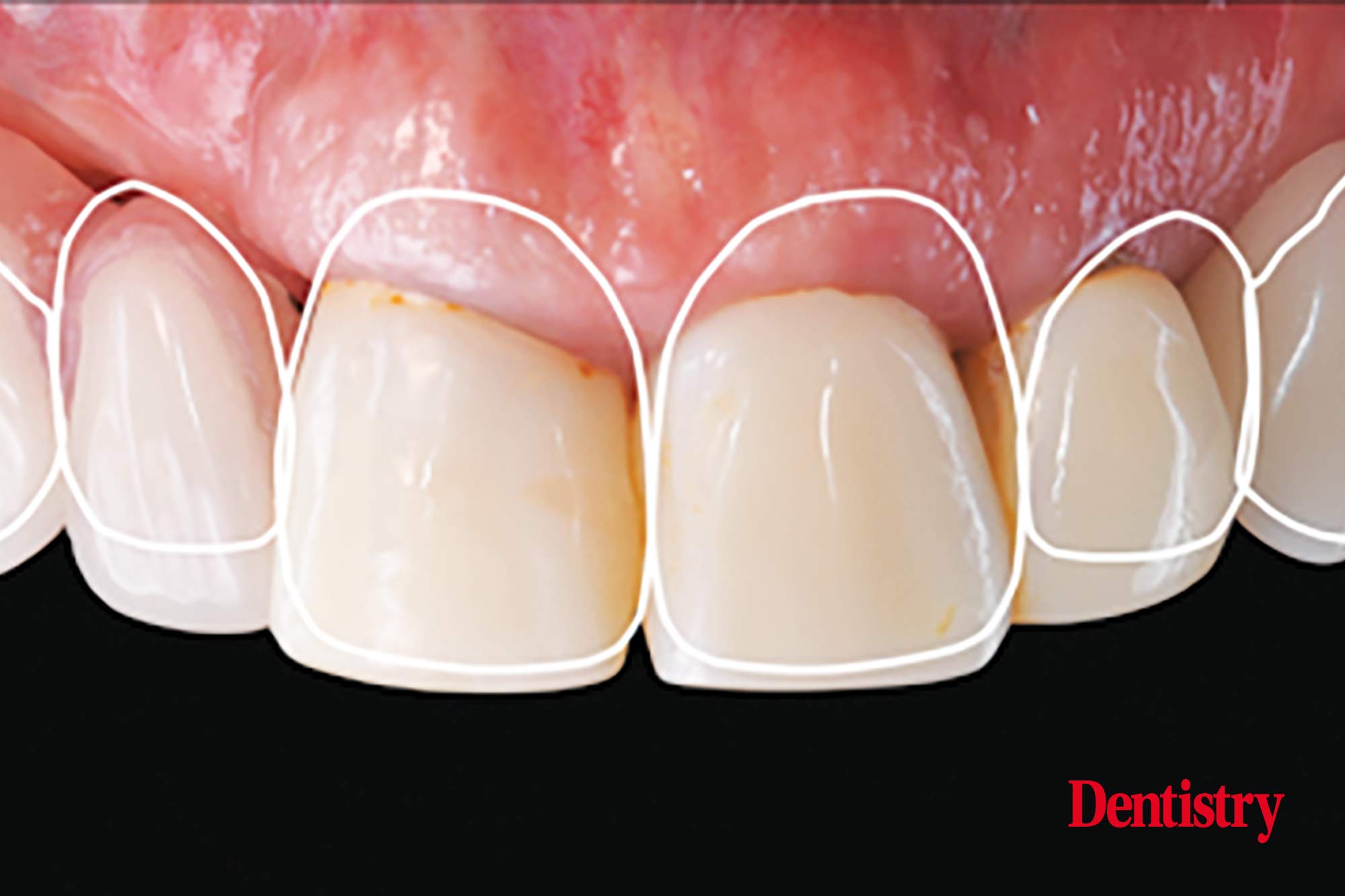 Digital workflow: a game changer for implant restoration
