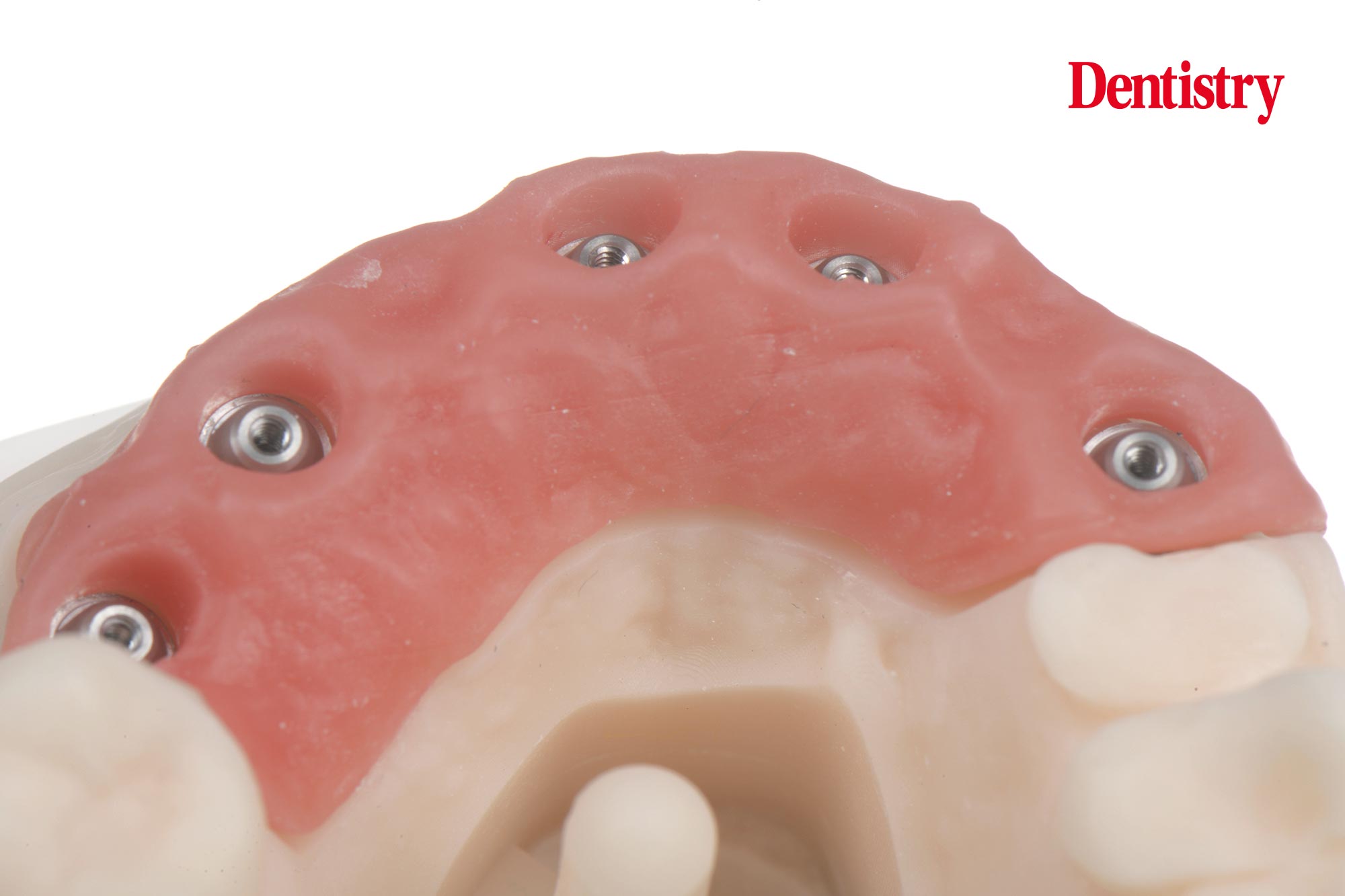 Digital workflow: a game changer for implant restoration