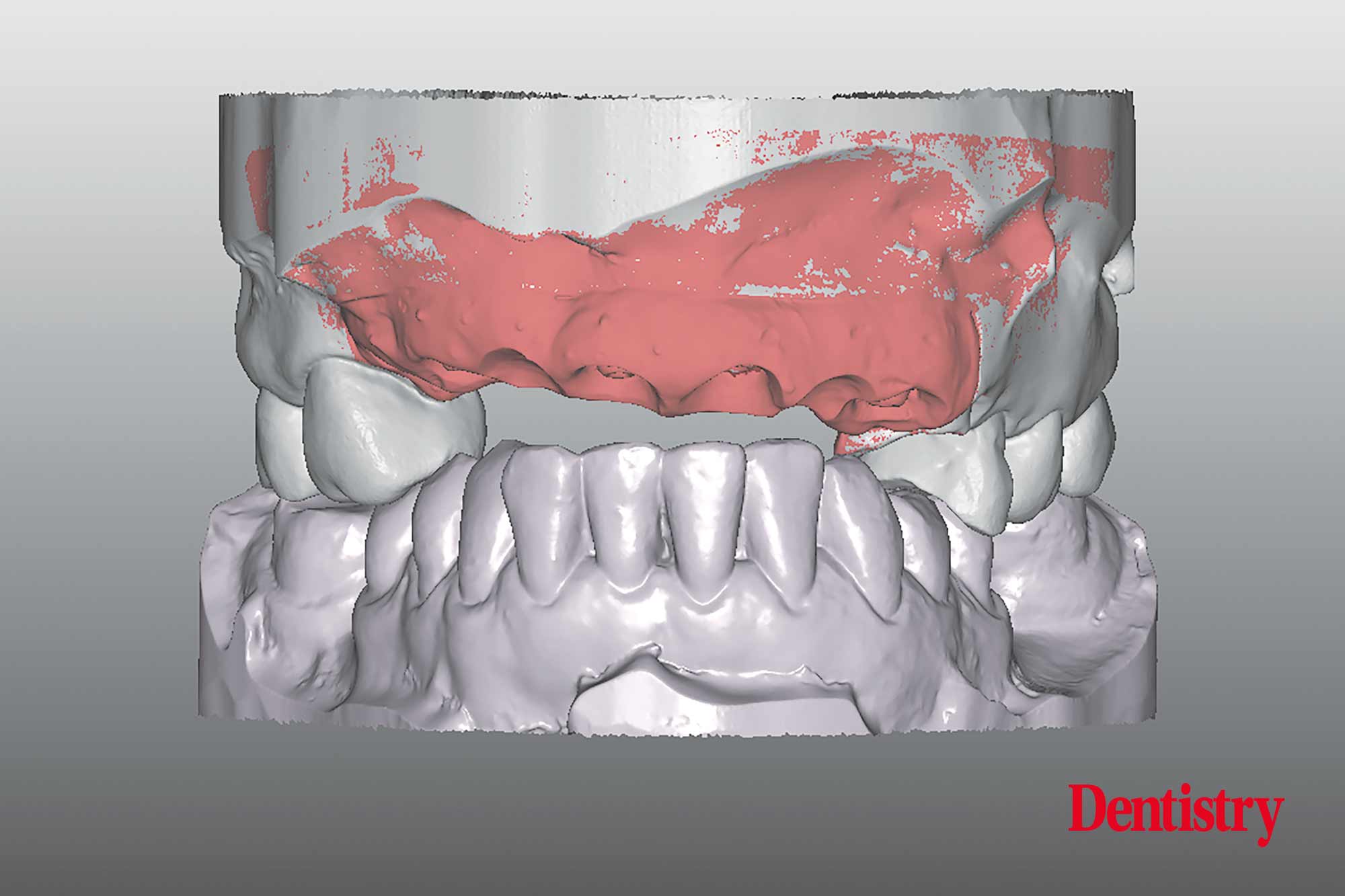 Digital workflow: a game changer for implant restoration
