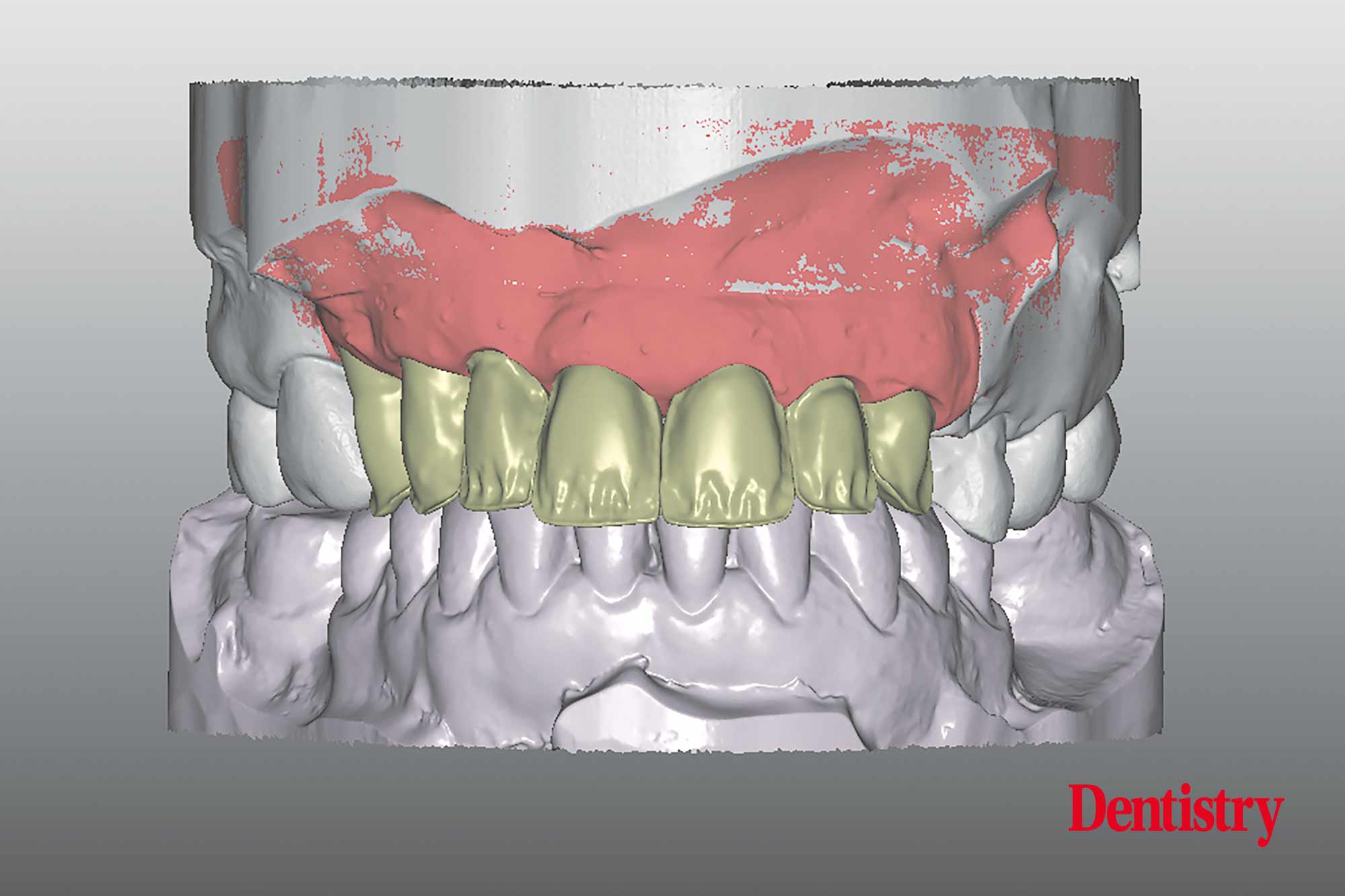 Digital workflow: a game changer for implant restoration
