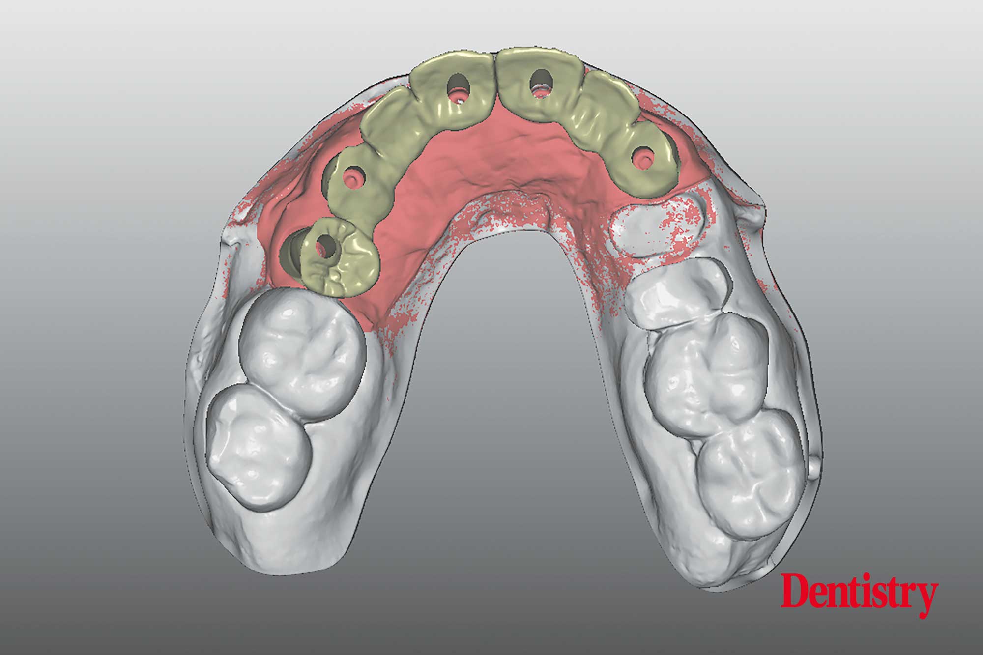 Digital workflow: a game changer for implant restoration