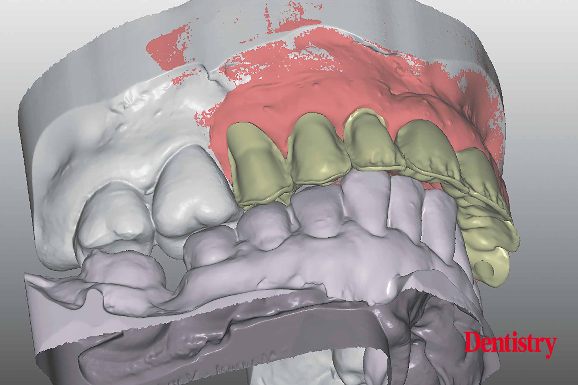 Digital workflow: a game changer for implant restoration