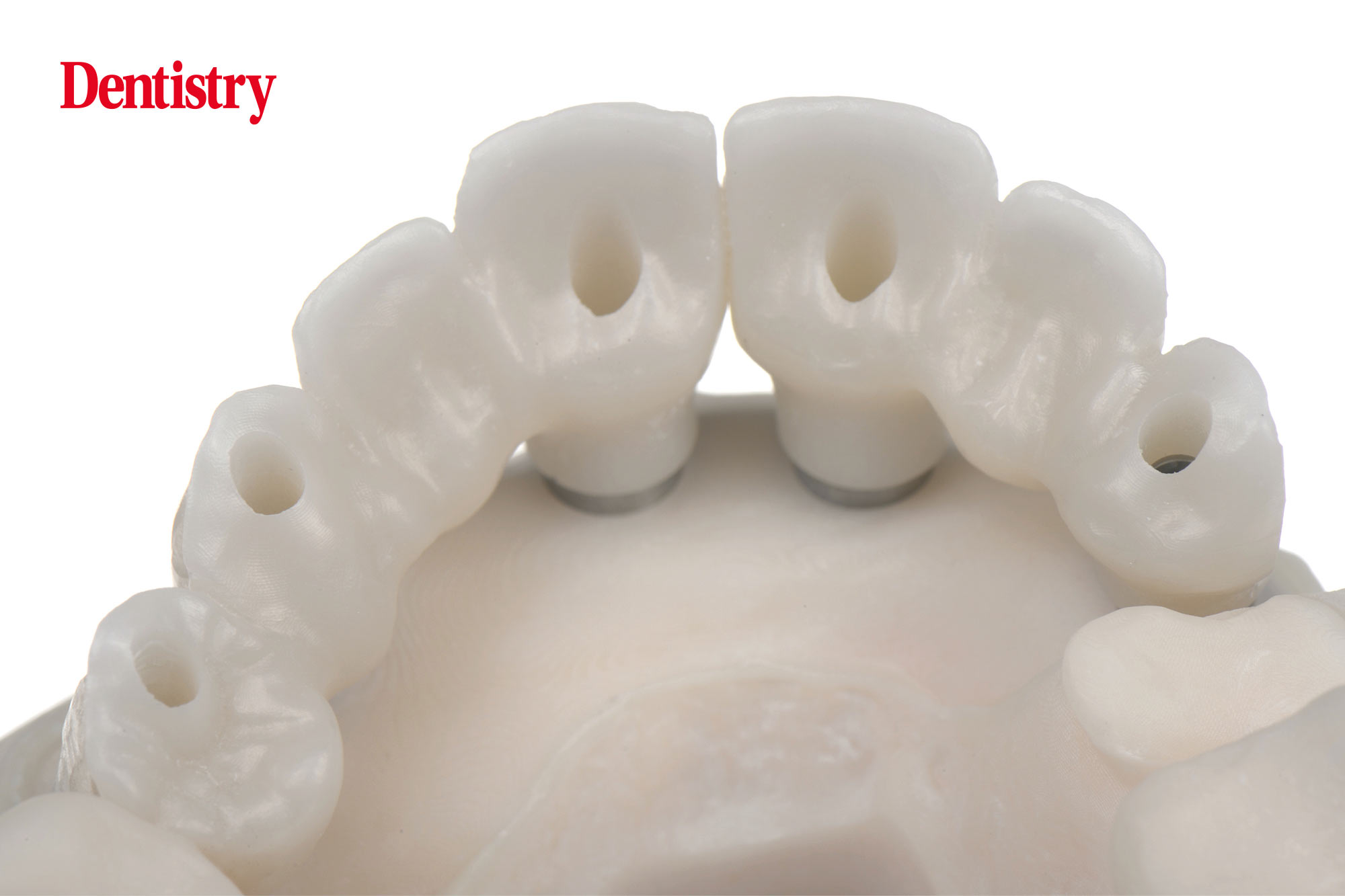 Digital workflow: a game changer for implant restoration