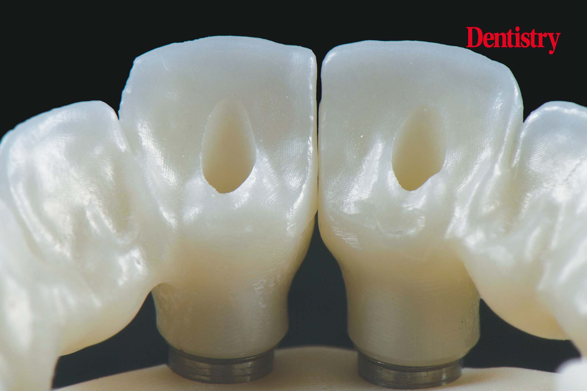 Digital workflow: a game changer for implant restoration