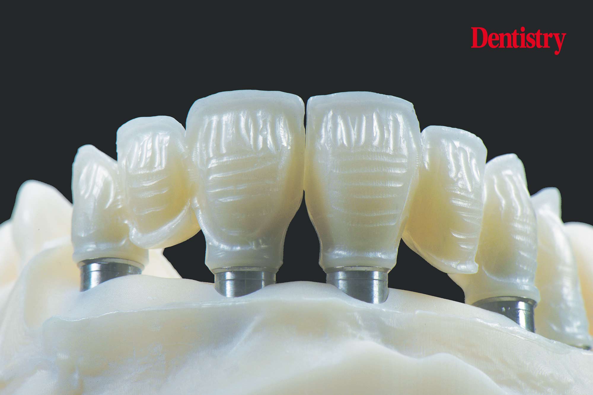Digital workflow: a game changer for implant restoration