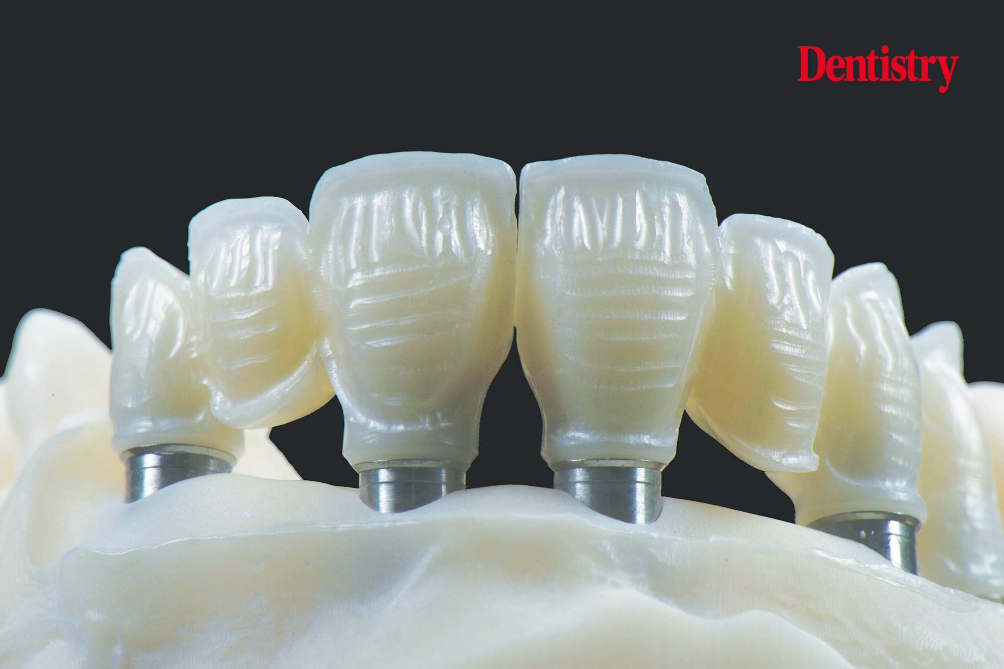 Digital workflow: a game changer for implant restoration